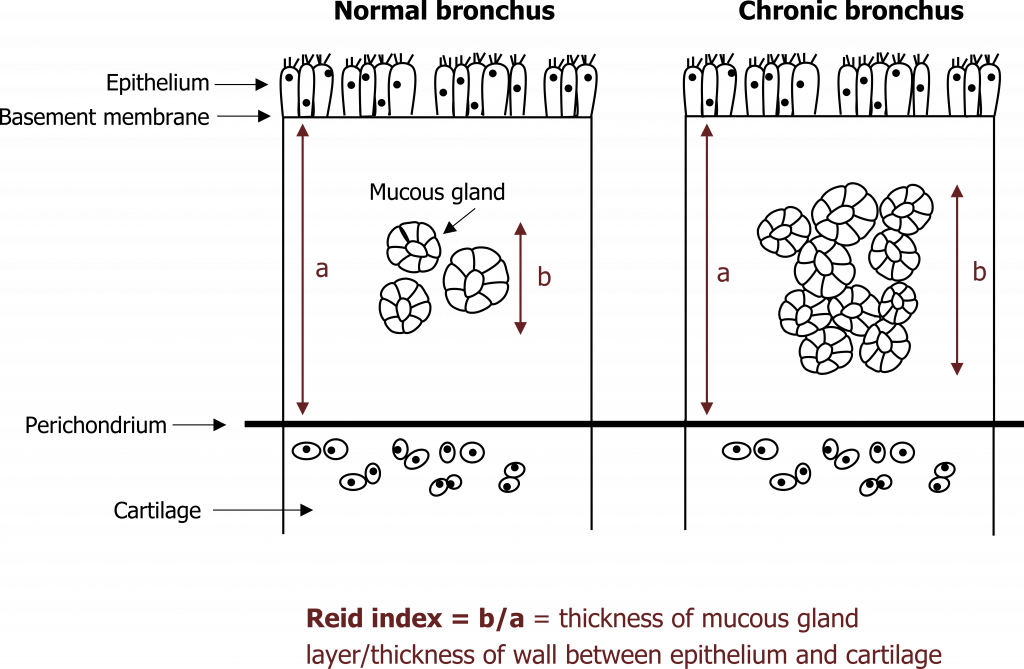 Normal bronchus drawn from top to bottom: epithelium, basement membrane, wall, perichondrium, cartilage. The wall between epithelium and cartilage is measured vertically with an arrow labeled a and has three mucous glands in the middle measured vertically with an arrow labeled b. Chronic Bronchus: the same diagram as normal bronchus but with 10 mucous glands and b is double the size. Reid index = b / a = thickness of mucous gland layer/thickness of wall between epithelium and cartilage.