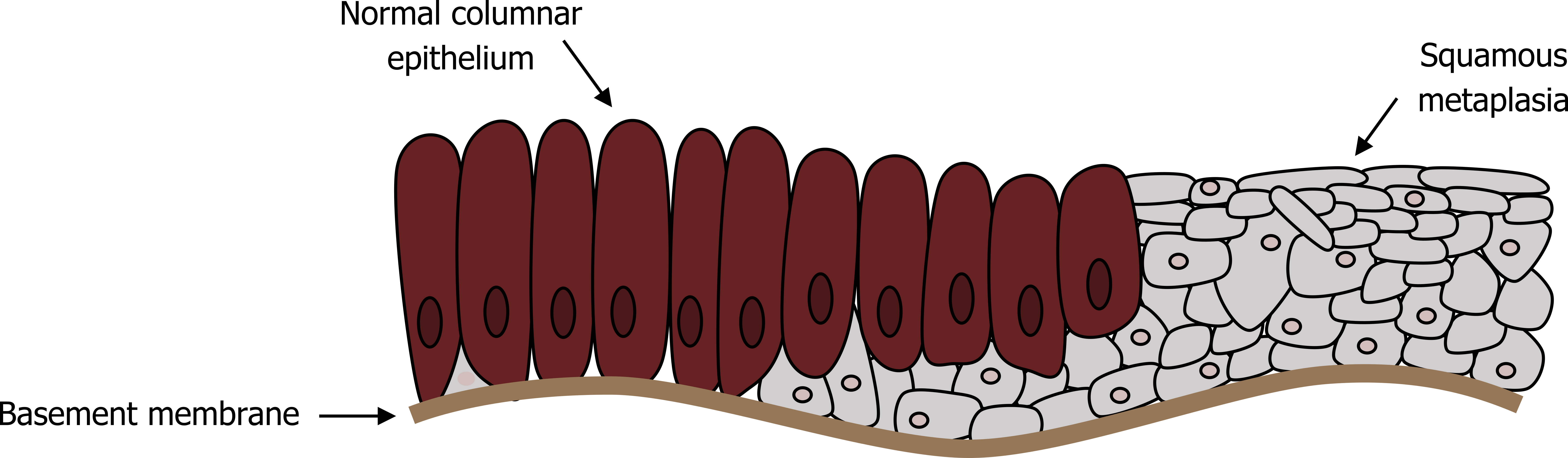 Cartoon of airway epithelium section shown with normal rectangular shaped cell projecting in the airway lumen on the left of the cartoon. These colored red are labelled normal columnar epithelium. Towards the right these normal cells transition is a overlapping more circular depictions of cells. These cells are colored gray and labelled squamous metaplasia.