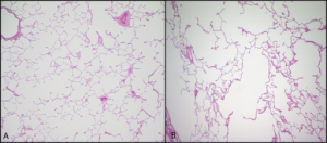 Two histology slides of lung tissue placed side by side for comparison. On the left is normal lung tissue showing intact alveolar architecture of small, regular spaces enclosed by pick alveolar walls. The right slide is labelled as emphysematous tissue and shows loss of alveolar walls producing larger spaces.