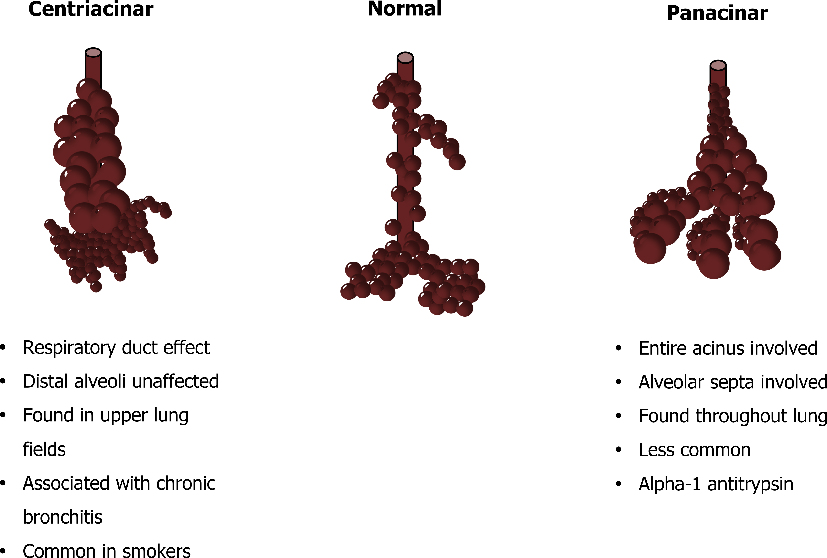 Centriacinar: respiratory duct effect, distal alveoli unaffected, found in upper lung fields, associated with chronic bronchitis, common in smokers. Panacinar: entire acinus involved, alveolar septa involved, found throughout lung, less common, alpha-1 antitrypsin