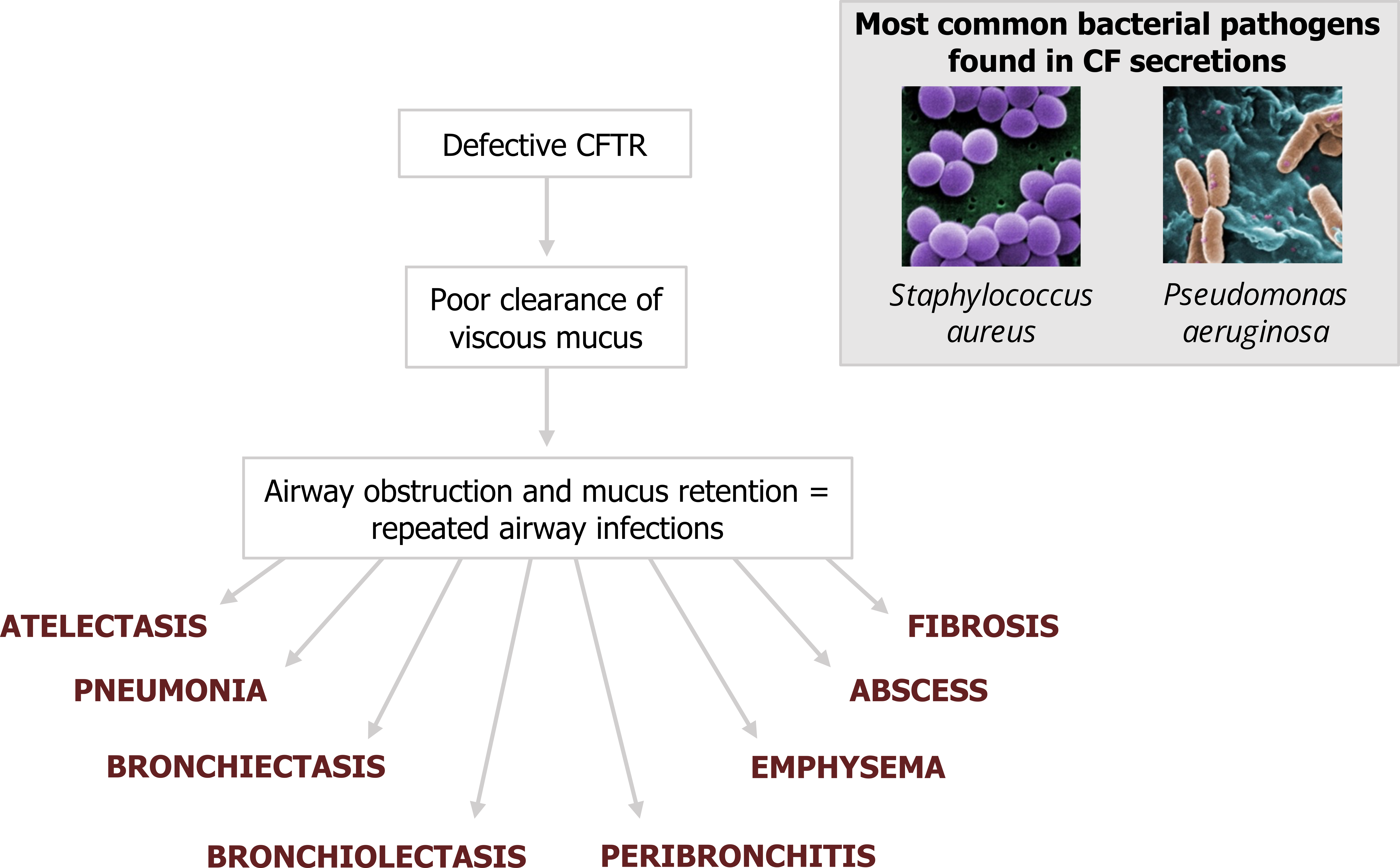 Defective CFTR arrow to poor clearance of viscous mucus arrow to airway obstruction and mucus retention = repeated airway infections arrows to atelectasis, pneumonia, bronchiectasis, bronchiolectasis, peribronchitis, emphysema, abscess, fibrosis. Most common bacterial pathogens found in CF secretions: Staphylococcus aureus and pseudomonas aeruginosa.