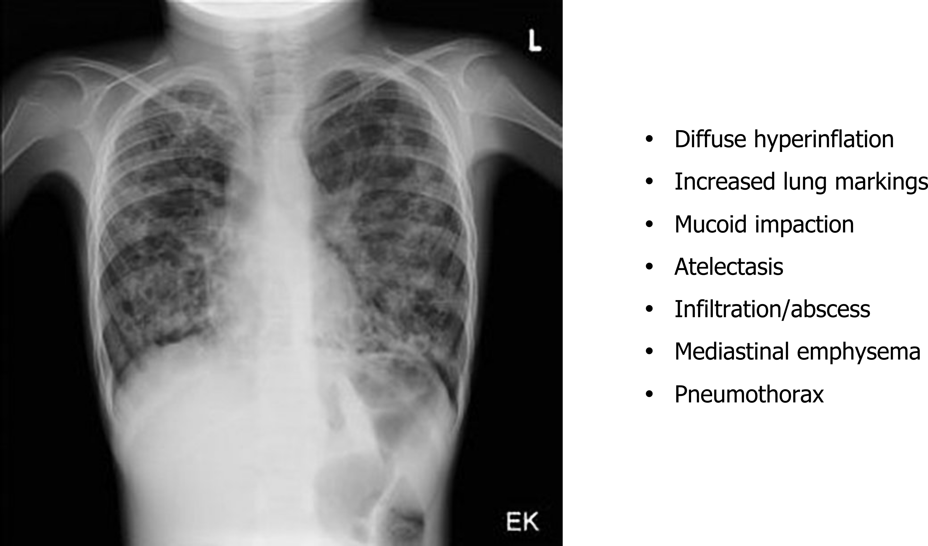 Diffuse hyperinflation, increased lung markings, mucoid impaction, atelectasis, infiltration/abscess, (mediastinal emphysema), (pneumothorax)