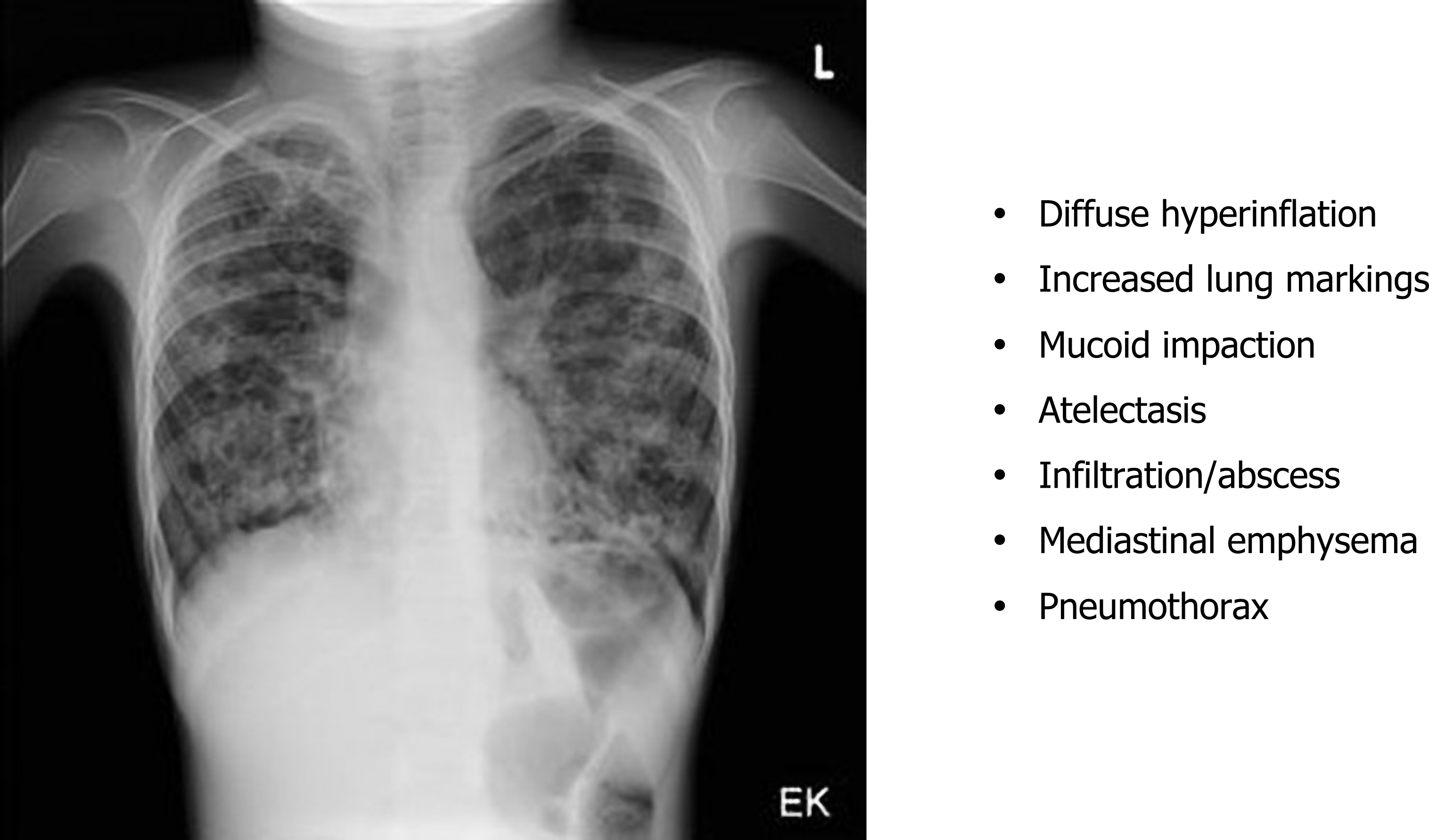 Bell-shaped chest resulting from insufficient intercostal muscle