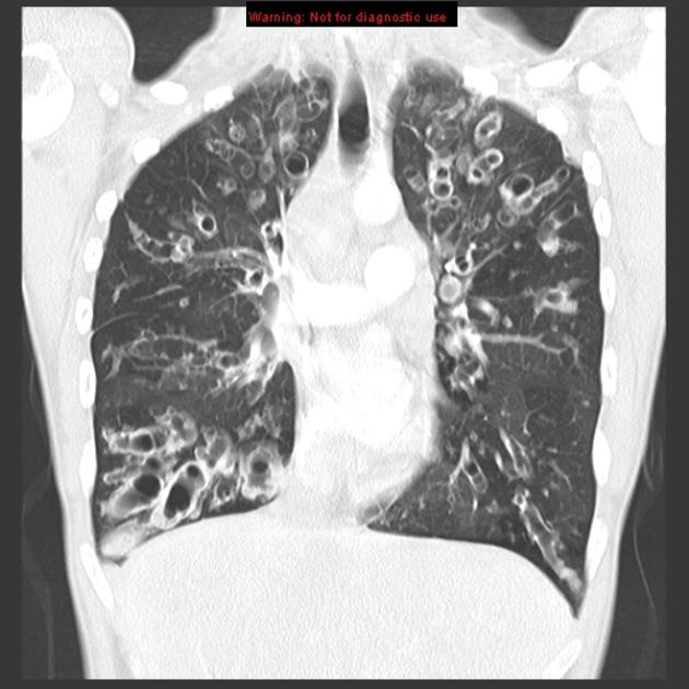 CT Coronal view of of cystic fibrosis lungs. Lung section shows large holes in lung tissue at apex and base of both lungs. Holes have elongated appearance reflecting track of expanded, dilated bronchioles.