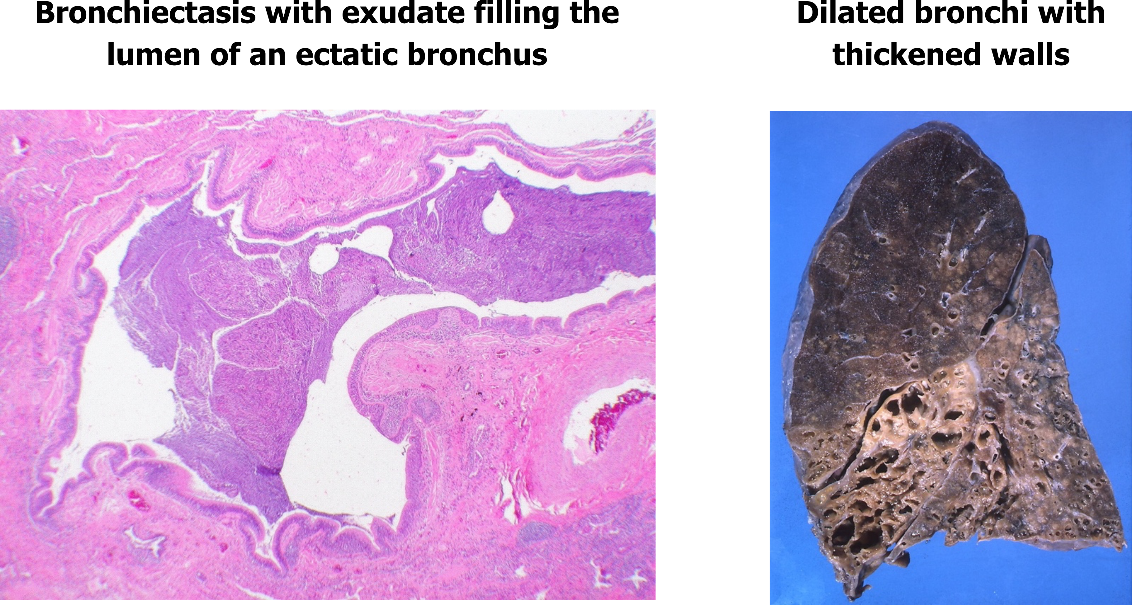Two images show the pathology of bronchiectasis. To the left is a histological slide of a a dilated airway, the lumen of the airway is enlarged and filled with a purple stained mass that is exudate. To the right is a gross anatomy image of a coronally sectioned right lung, the lower lobes of the lung show enlarged open spaces within normal more dense lung tissue.