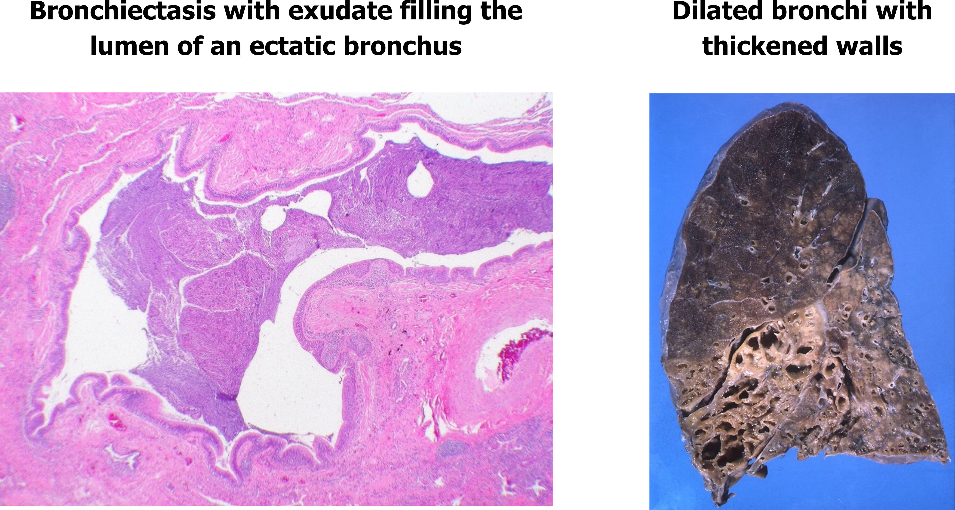 bronchiectasis histology