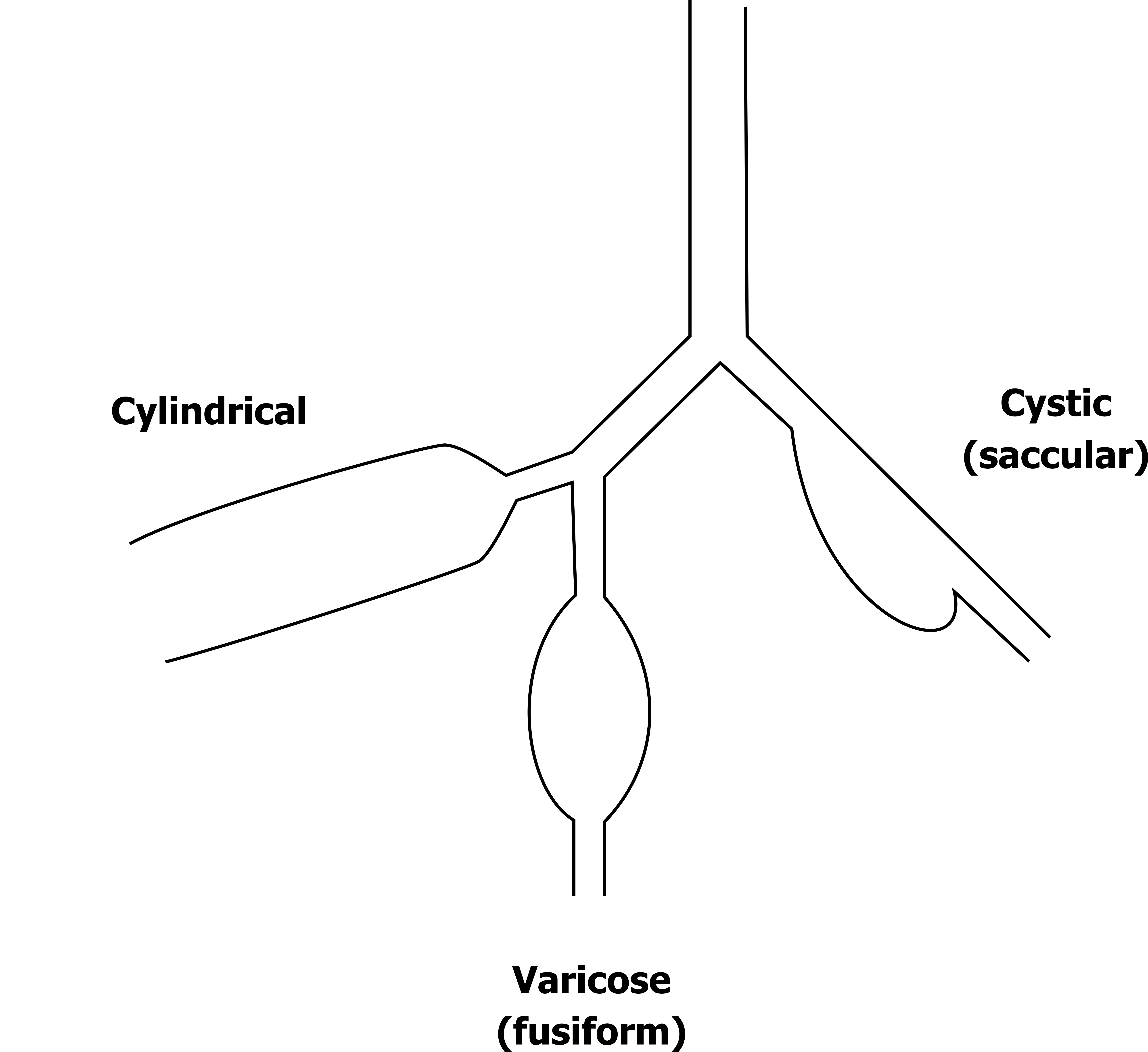 A cartoon show three forms of bronchiectasis within a section through a branching airway. The first shows uniform, parallel dilation of an airway with walls expanded on both sides and this is labelled 'cylindrical'. The second is labelled varicose (fusiform) with both airways ways showing a progressive dilation and then tapering back to a normal diameter lumen.The third is labelled cystic (saccular) with only one wall bulging outward then tapering back toward a normal diameter.