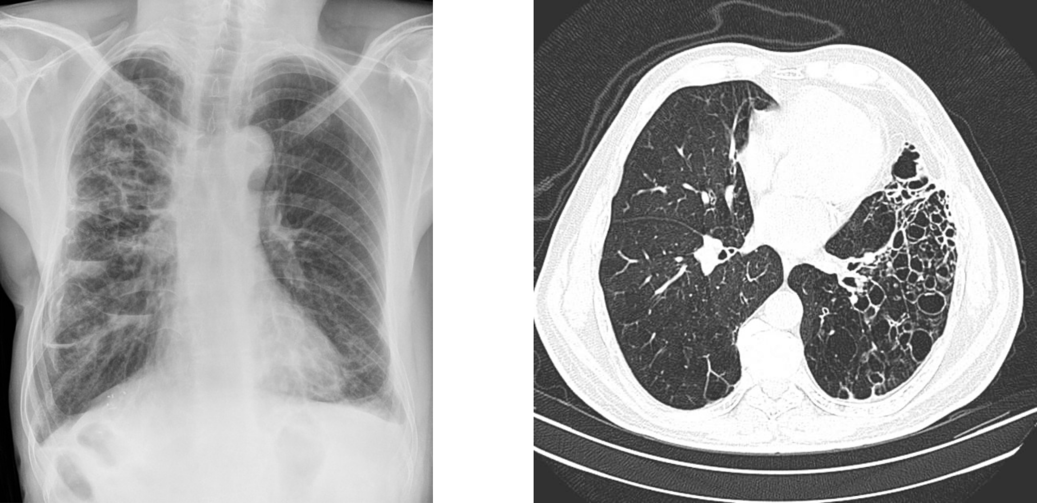 Two panels are side by side . The one of the left shows an x-ray with interstitial markings throughout all lung fields. The markings follow the distinct tracts reflecting inflammation and increased tissue density following the path of large airways. The second image on the right shows a transverse CT image of the base of the lungs and includes open spaces with a honeycomb appearance in the left lung.