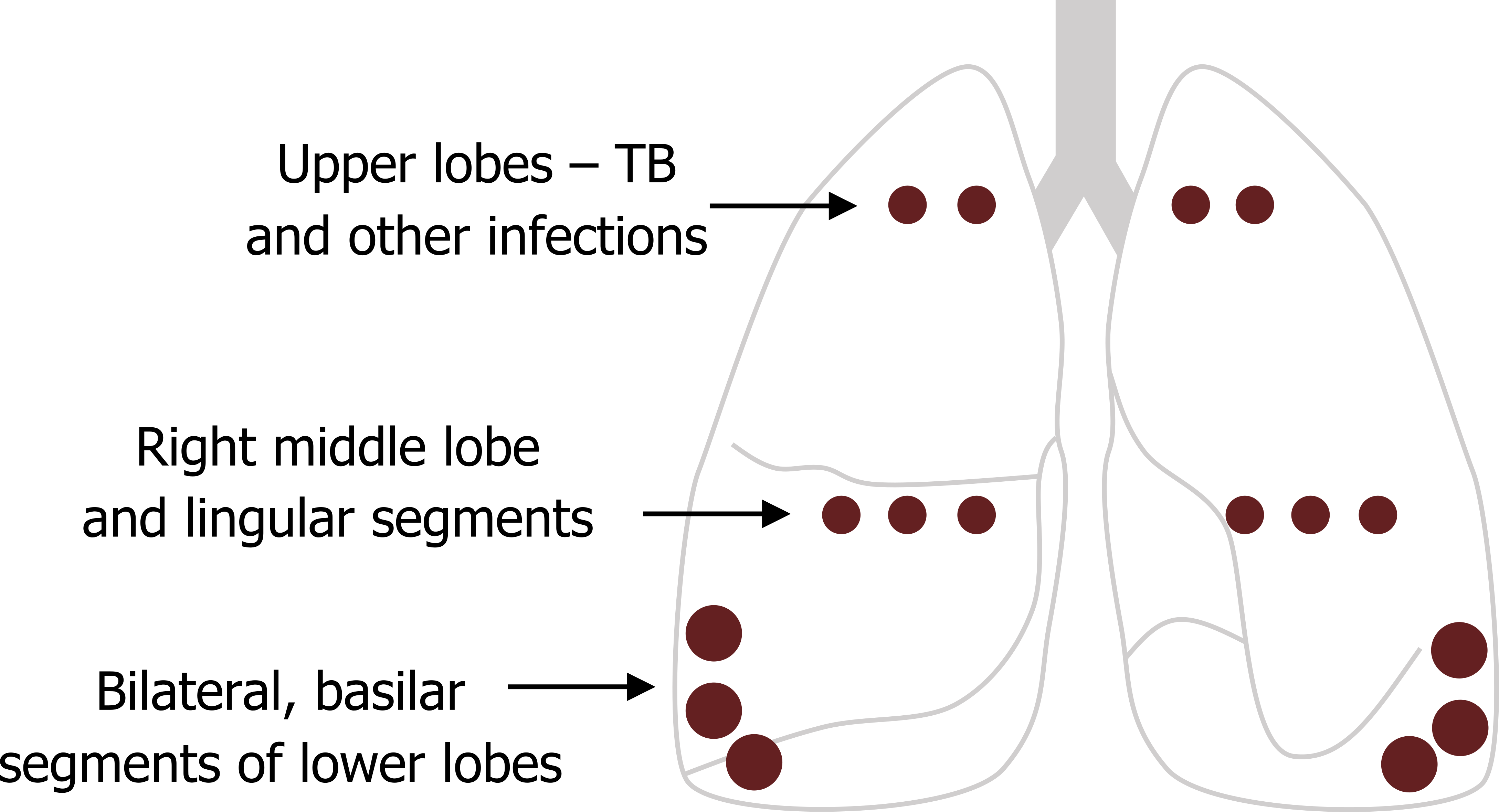 Outline of the lungs. From top to bottom: Upper lobes - TB and other infections. Right middle lobe and lingular segments. Bilateral, basilar segments of lower lobes.