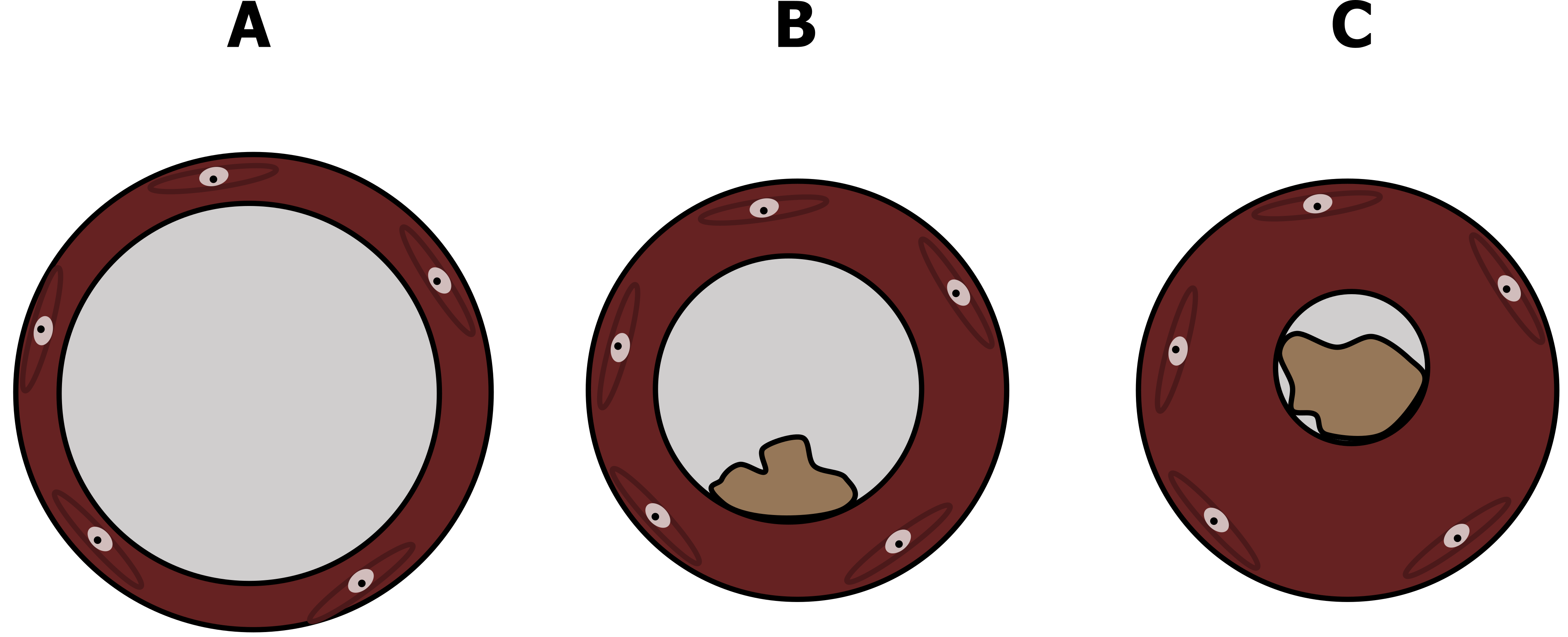 a) Circular lumen surrounded by the airway wall. b) Increased thickness of the airway wall, decreased circumference of lumen, and a small amount of mucous. c) Further increased thickness of the airway wall, further decreased circumference of lumen, and double the amount of mucus