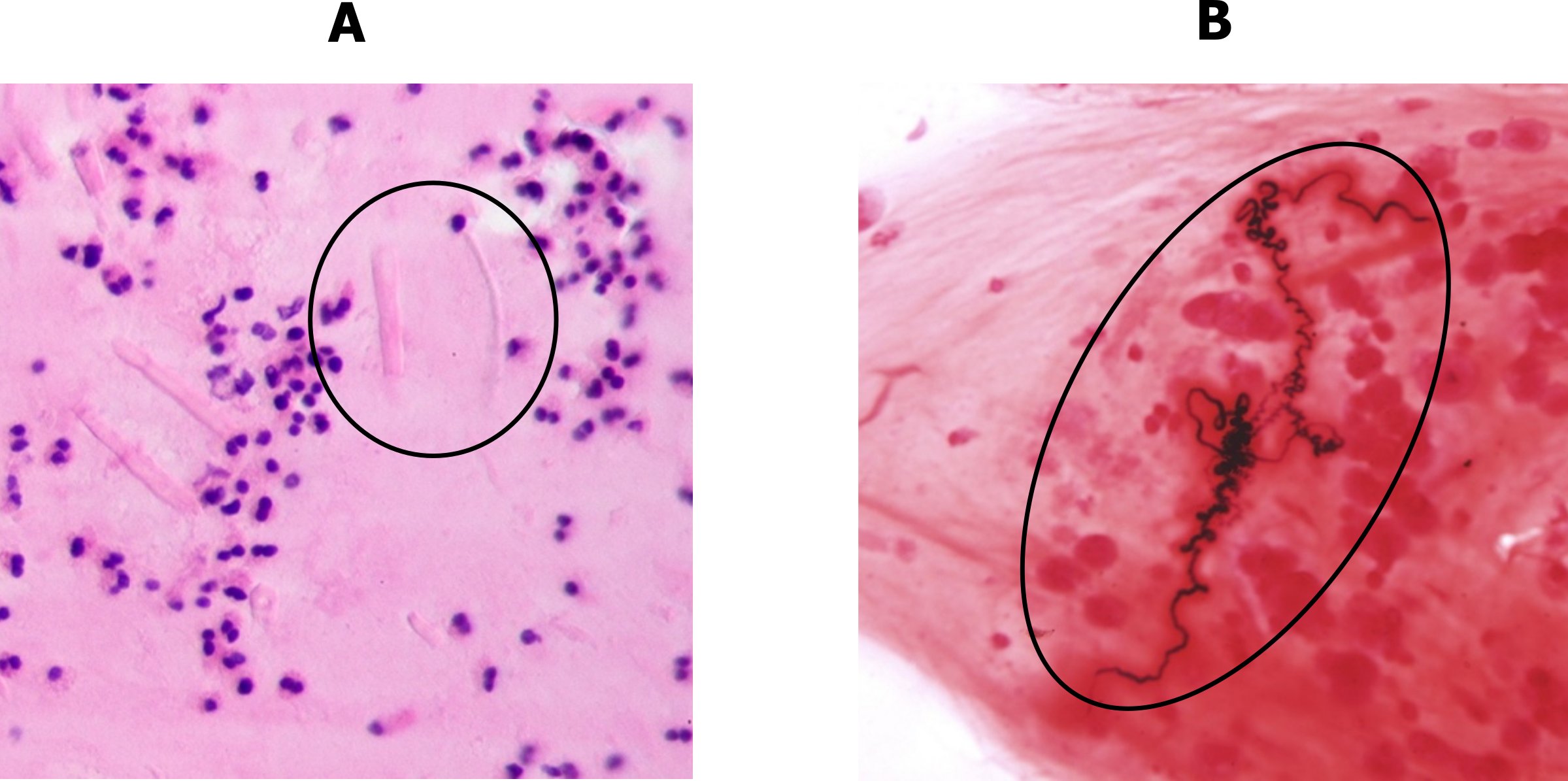 Two micrograph slides are side-by-side, one labelled A the other is labelled B. Slide A shows an deep purple dots that are eosinophils and also pale pink elongated rectangular structures two of which are circled and labelled as Charcot-Leyden crystals. Slide B shows a micrograph of a sputum sample that includes deep red spirally lines that are circled and labelled as Curschmann's spirals.