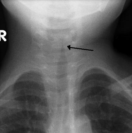 Image shows an x-ray of a child's upper airway. The darker trachea is seen to narrow and come to an upward facing point. An arrow points at the narrowing.