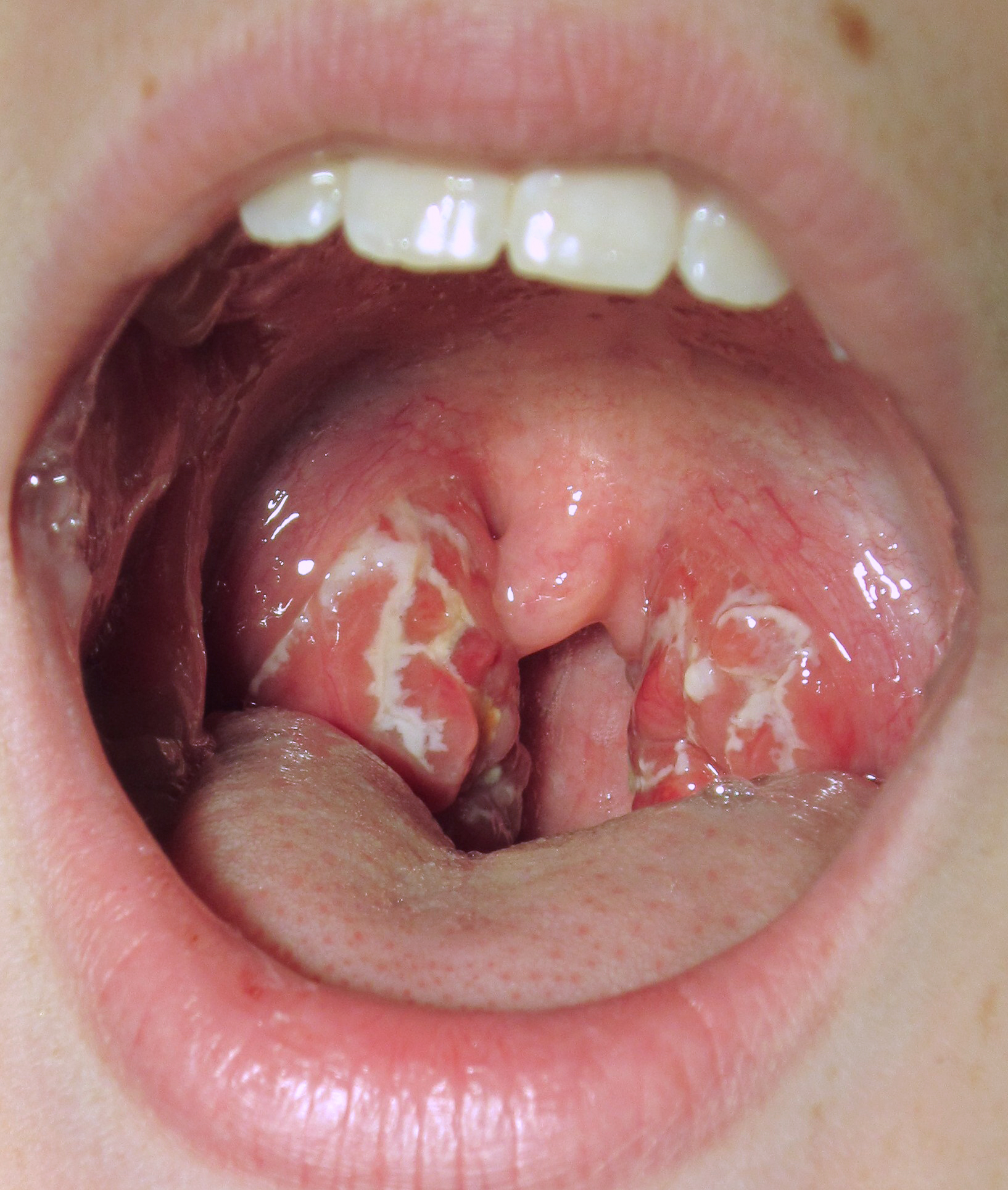 Petechiae on palate, pus in tonsils, inflammation of pharynx