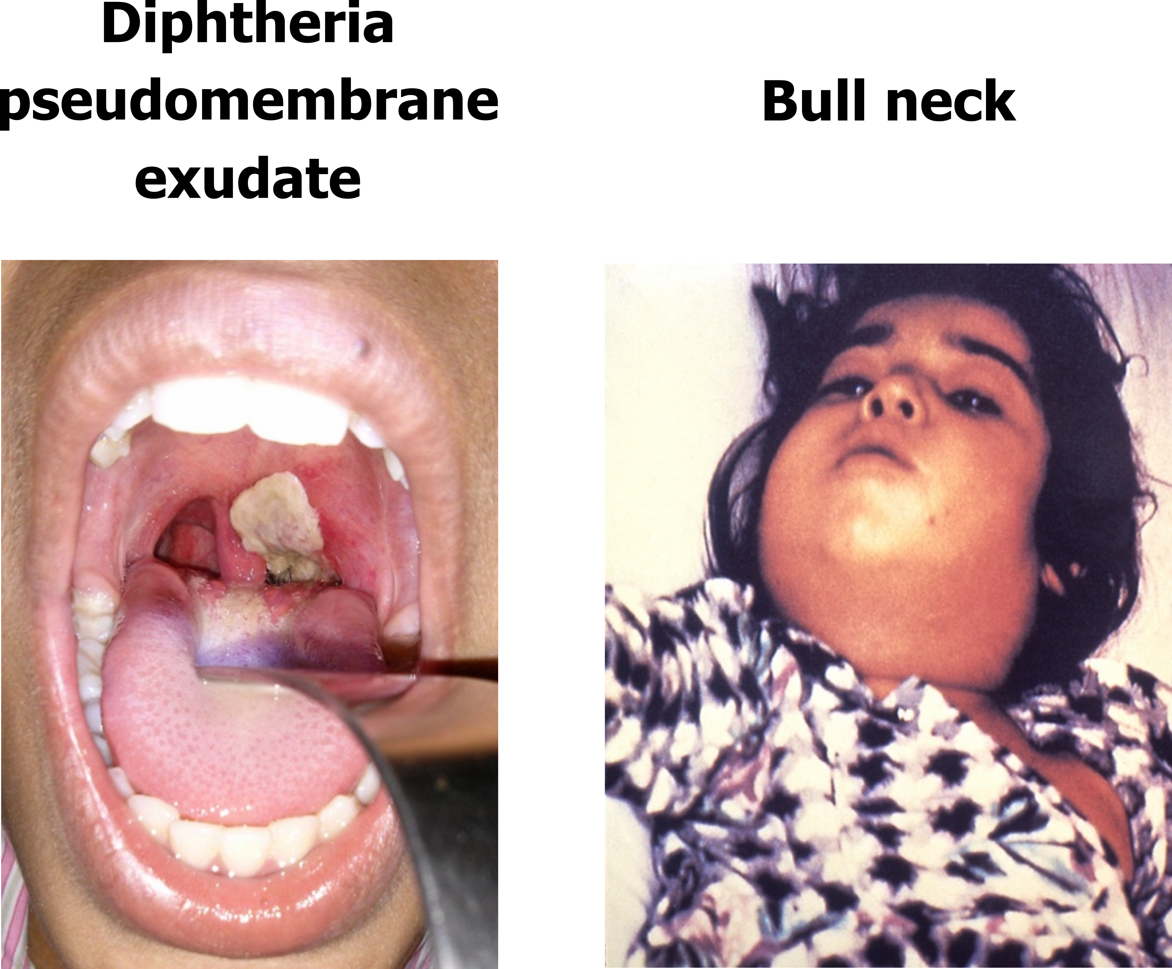 Two images show pathological indications of C. Diphtheriae. The first on the left is a photo of an open mouth with a depressor pushing the tongue down to reveal thick exudate covering the uvula and tonsils. The second photo on the right shows a recumbent child whose neck is severely engorged.