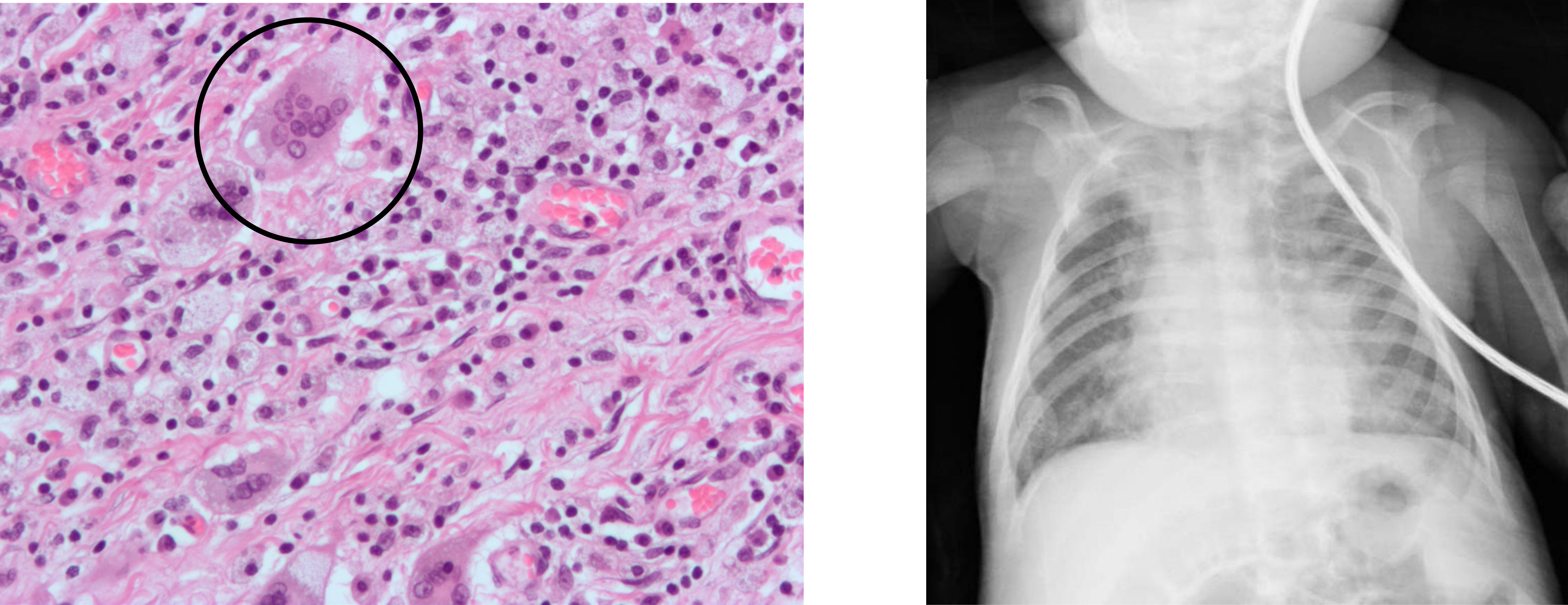 Two panels show examples of RSV infection. The first (left) is a histology slide of consolidated airspace within which a circled area shows a large cell with multiple nuclei (syncytial giant cell). The second image (right) is a chest x-ray of a child. Areas of increased tissue density are apparent around the position of the sternum indicating inflammation that follows the tracts of the major bronchi.