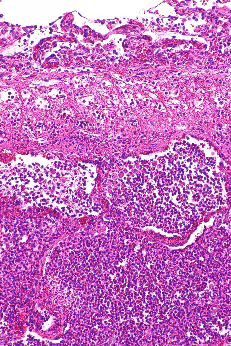 A histological slide shows consolidated airspace. Outlines of alveolar walls are apparent but within the contained airspace are numerous purple dots indicating the presence of neutrophils and bacteria.