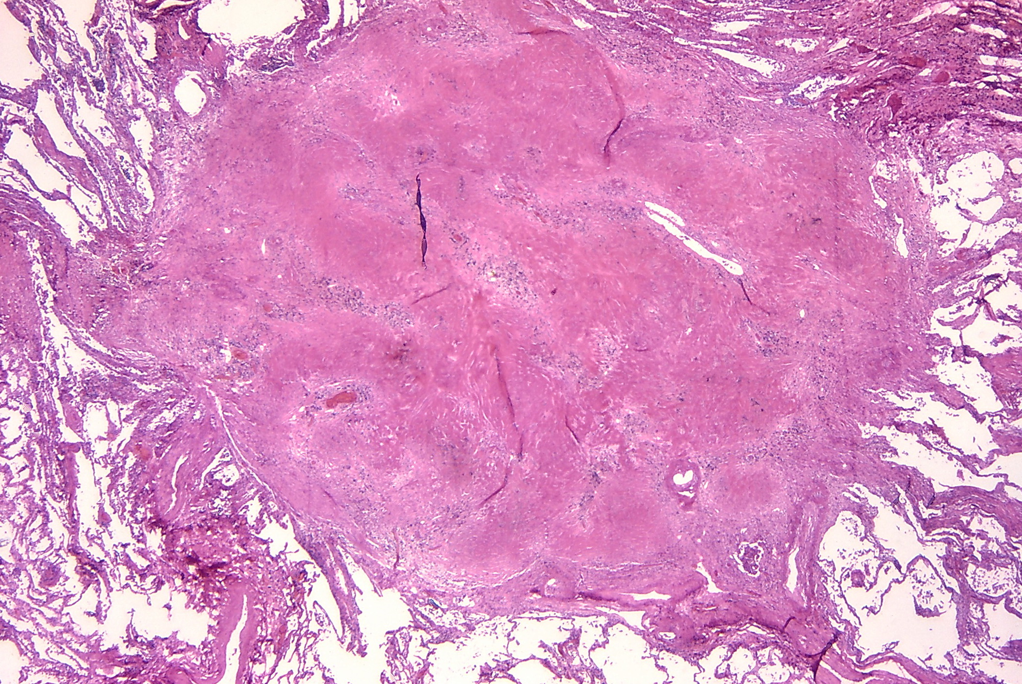 histological slide of lung tissue containing a solid-looking mass of tissue that is surrounded by normal lung tissue.