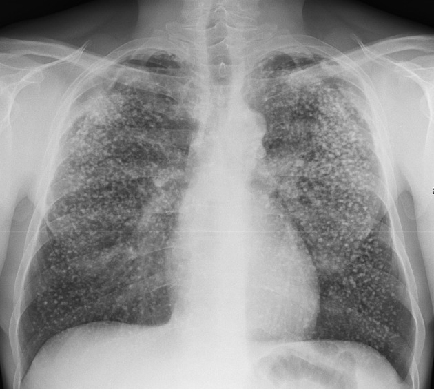 A chest x-ray shows numerous small white densities throughout all lung fields