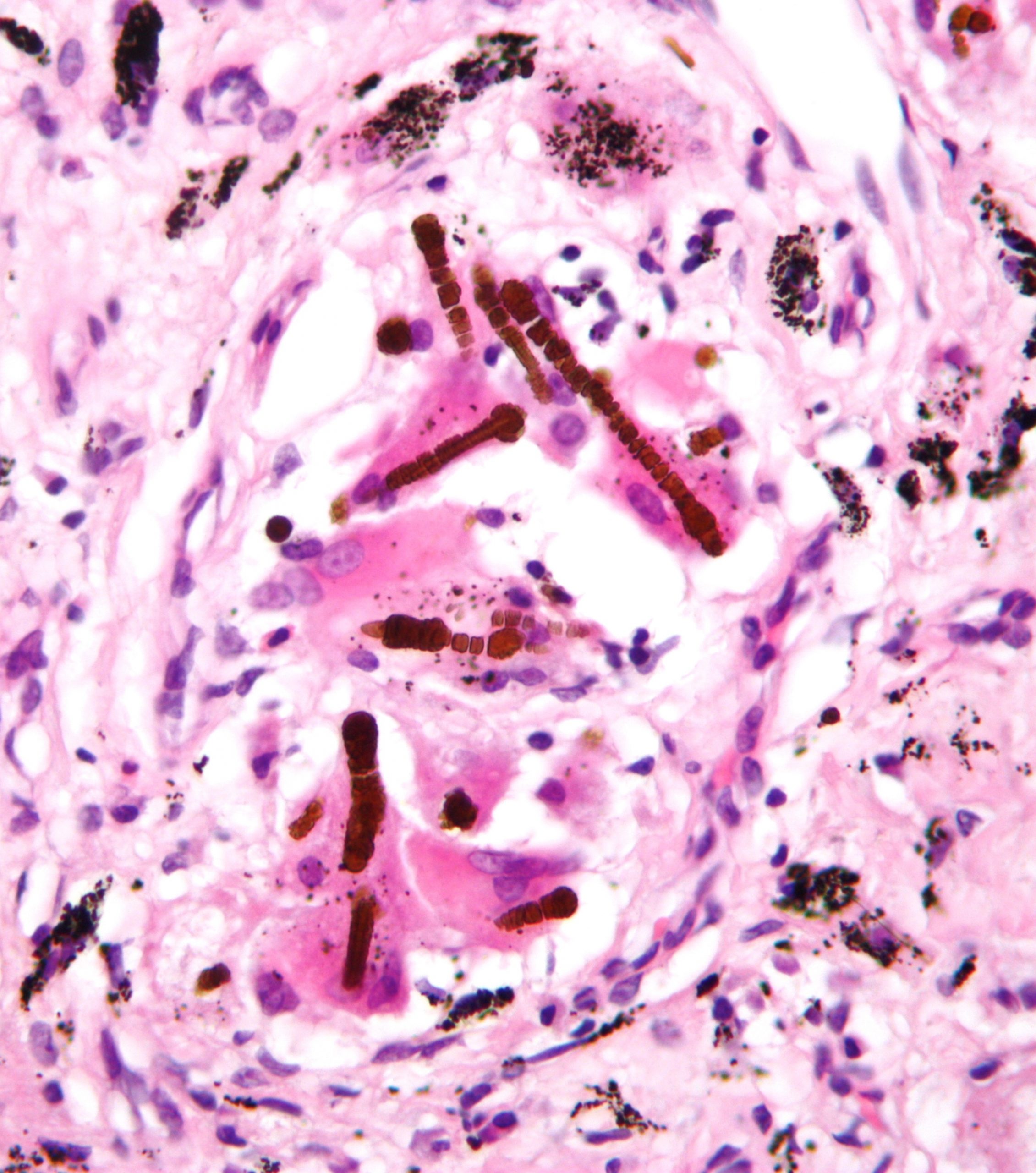 Histological slide of lung tissue shows darkly stained elongated pole like particles embedded in lung parenchyma