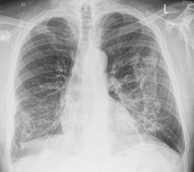 Chest x-ray shows diffuse densities concentration out toward the peripheral airways.