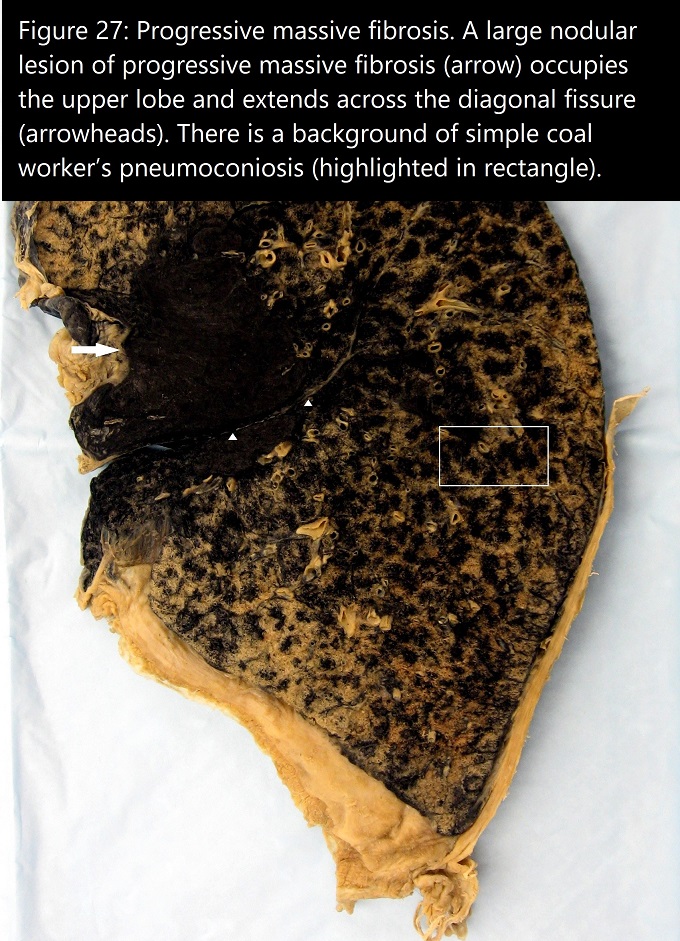 Gross anatomy of lung with coronal section shown. Lung is solid black at the hilar region with patchy black spots throughout the other lung fields.