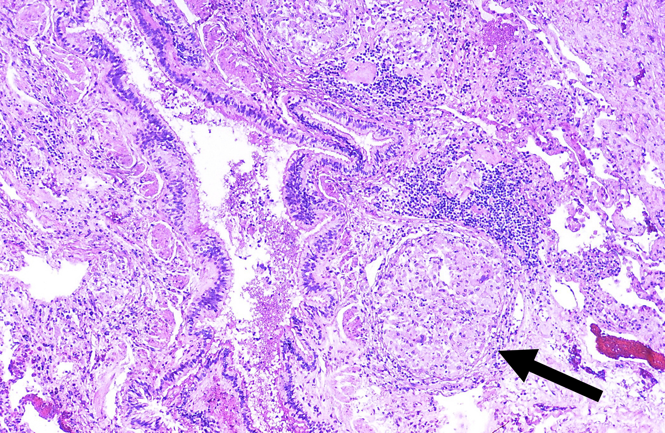 Histology slide of lung tissue with arrow pointing to a dense area of abnormal tissue. The dense area has a patchy appearance with a layer of organized tissue surrounding a less organized core.