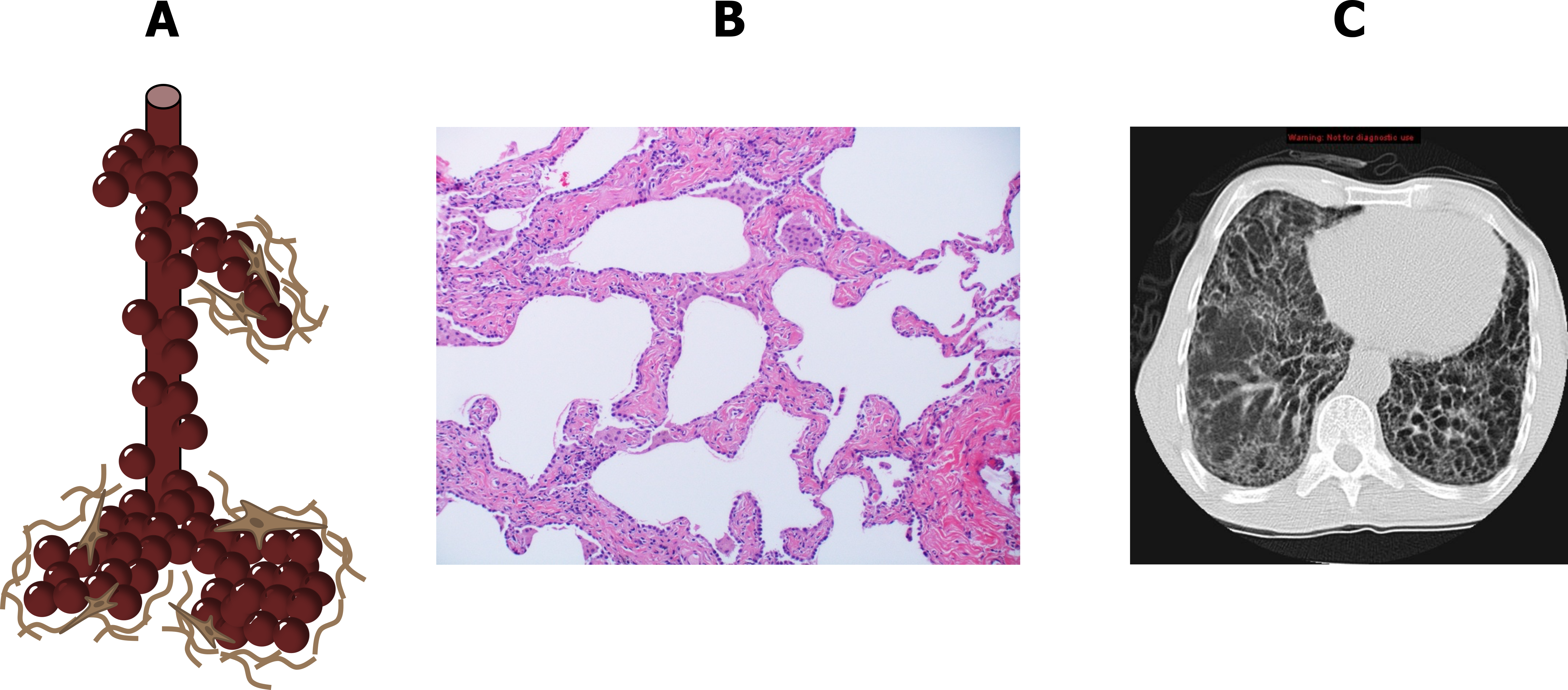 Three panels show different views of interstitial lung disease. The first (left) is a cartoon of an acinus in red that includes alveolar sacs as branches of an alveolar duct. The alveolar sacs are surrounded by brown lines depicting fibrotic material. The second image (middle)is a histological slide of alveolar walls that are thickening and contain fibrotic material. The third image (right) is a transverse section of a CT image of the lung. Distinct, abnormal tissue is apparent with a distinct honeycombing pattern of large 'holes' in the lung tissue.