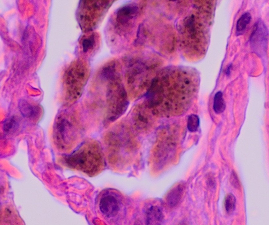 histological image showing one alveolus. Within the single encapsulated airspace are a group of brown-colored cells.