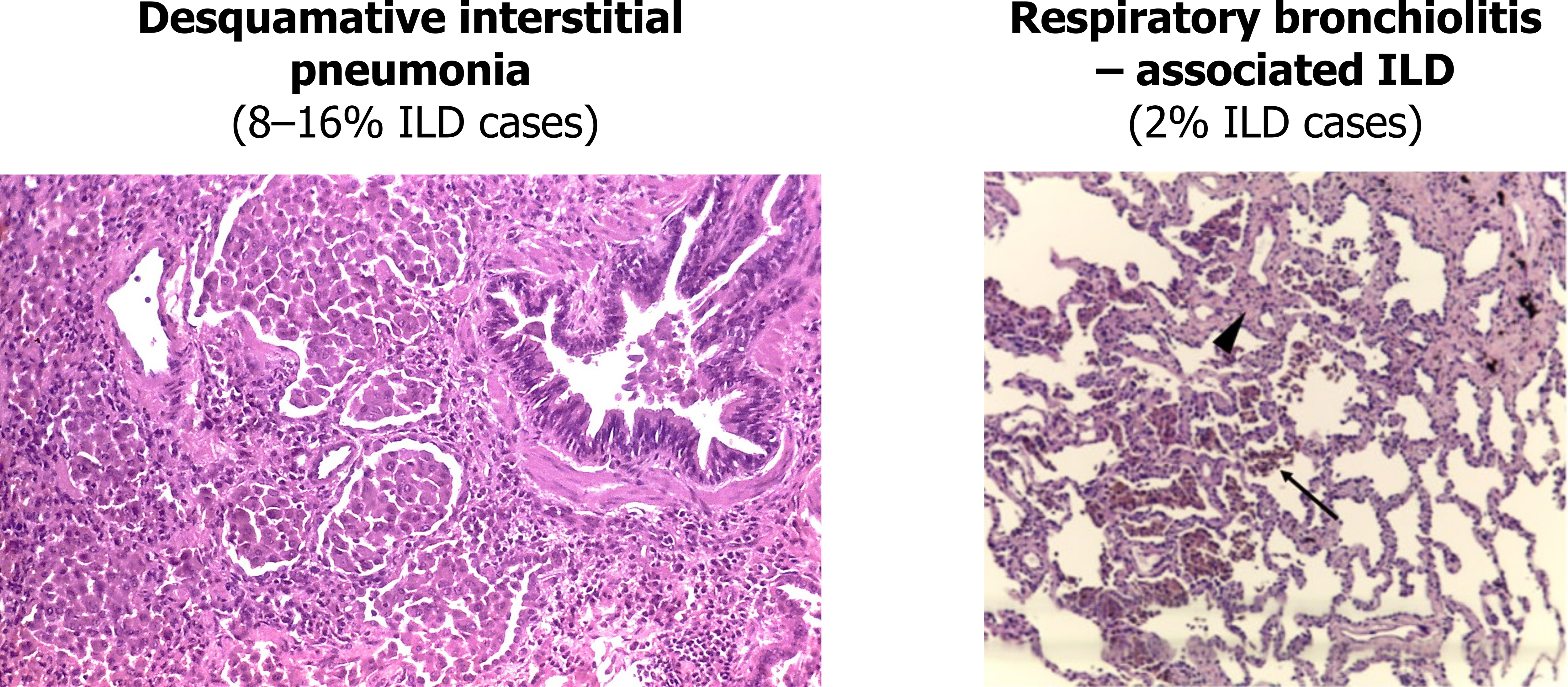 Desquamative Interstitial pneumonia (8-16% ILD cases). Respiratory bronchiolitis associated ILD (2% ILD cases)