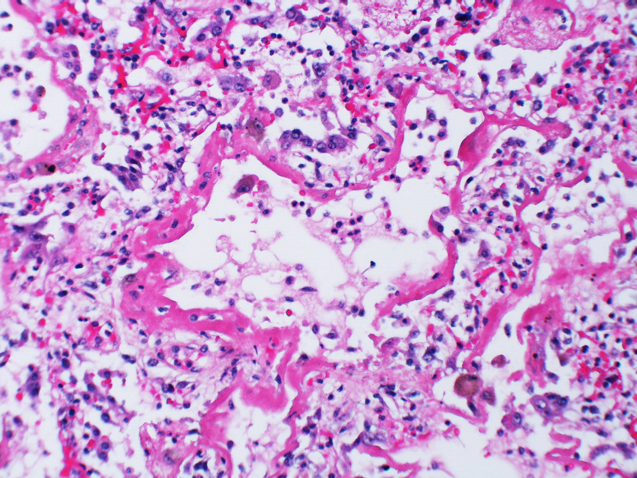 Histological image of three alveolar spaces with debris inside of airspace and thickened interstitial space between the alveoli.