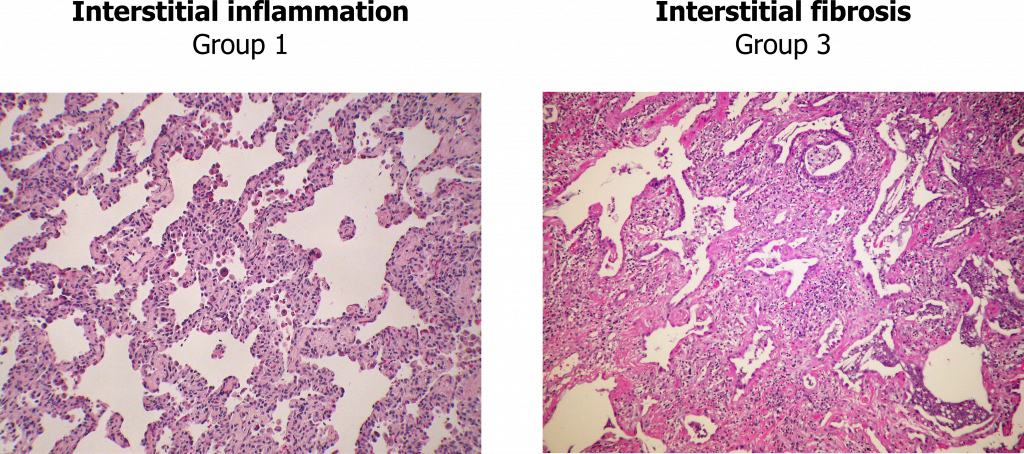 The Restrictive Lung Diseases – Pulmonary Pathophysiology For Pre ...