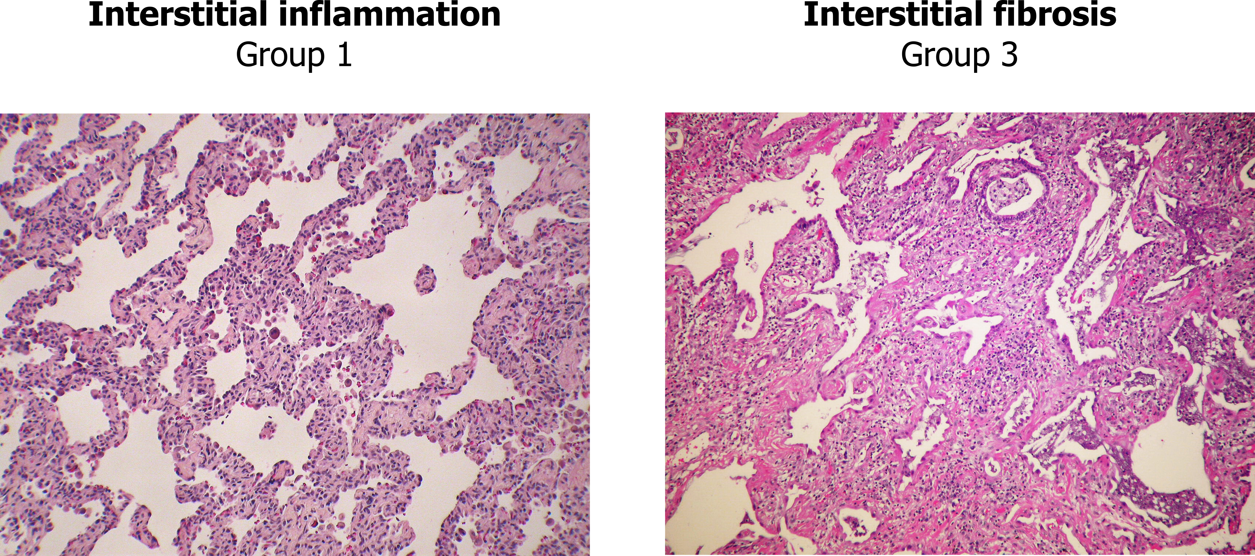 Two histological slides showing stages of nonspecific interstitial pneumonia. First slide shows thickened alveolar walls shown in inflammatory stage with infiltrate. Second slide shows fibrotic stage with increased thickness of alveolar walls and inclusion of fibrotic material.