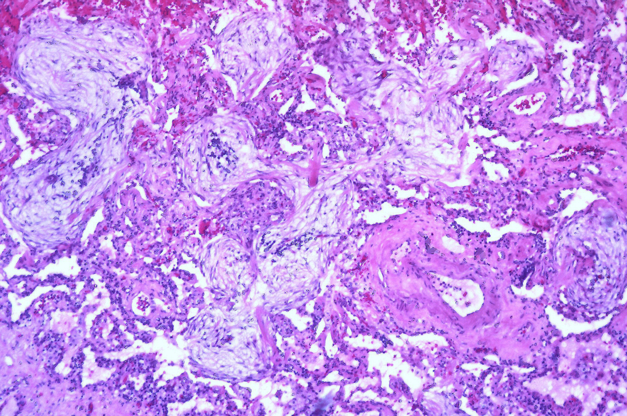 Histological slide of airspaces filled with fibrotic lesions. fibrotic material occupies the airspaces and transitions from one alveolus to the next generating a pattern of conjoined circles within the view.