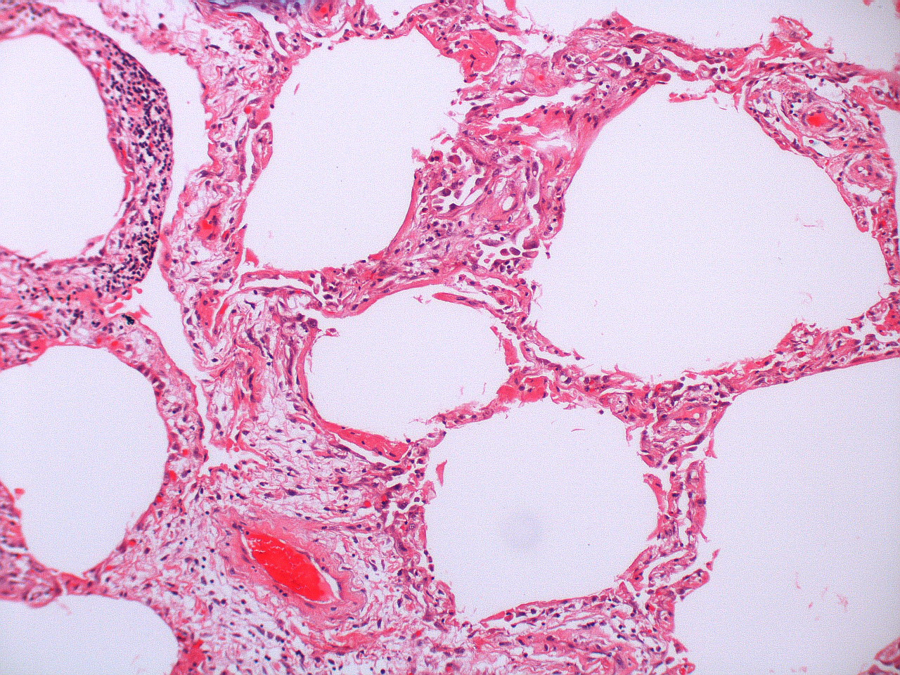 Histological slide of lung tissue. Alveoli are surrounded by severely thickened septum with darker dots of infiltrating cells seen in the walls. There is a capillary showing filled with a dark red circle indicating the presence of a clot.