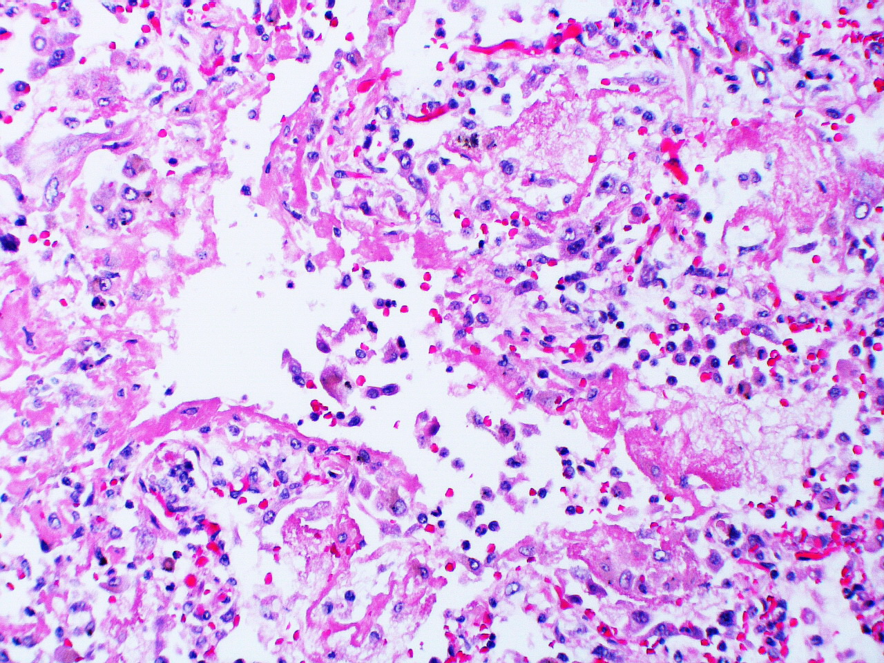 Histological slide of lung tissue showing a single distinct airspace with thickening of alveolar walls and debris accumulating in the air space.