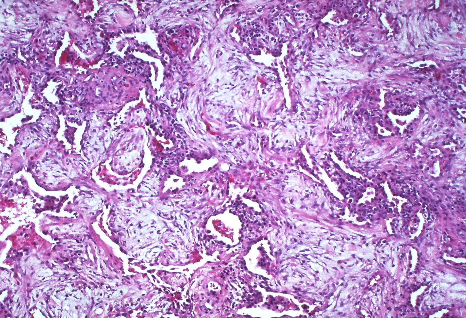 Acute Respiratory Distress Syndrome – Pulmonary Pathophysiology for Pre ...