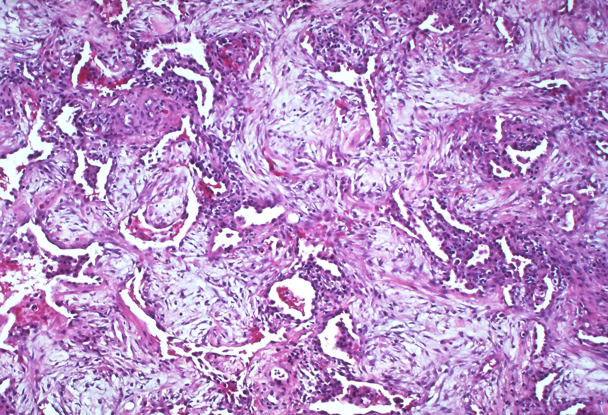 The histological slide show lung tissue with severely thickened interstitium. The interstitium contains swirling patterns of light colored material indicating the presence of fibrosis. The air spaces are narrowed and appear severely compressed.