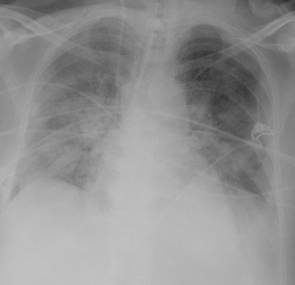 Chest x-ray (A-P image) shows diffuse, blotchy white markings that are seen throughout the lung fields but there is a higher density in the middle lobes in this particular patient.