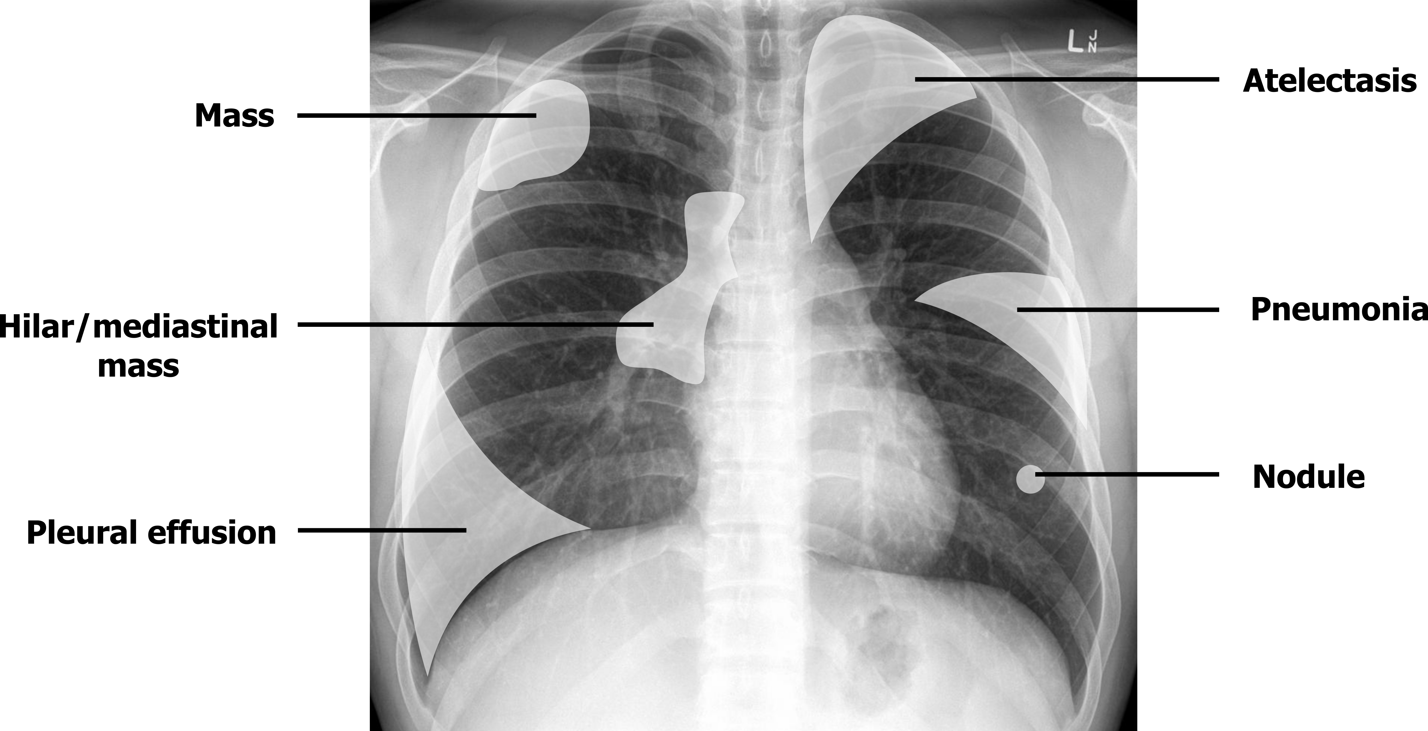 A normal A-P chest x-rays has opaque overlays showing potential sites of radiographic findings in lung. An overlay in the upper right lobe is labelled 'mass'. An overlay in the upper left lung is labelled 'atelectasis'. An overlay in the central region of the lung is labelled 'hilar/mediastinal mass'. An overlay in the middle left lobe is marked 'pneumonia'. An overlay in the right basilar region is labelled 'pleural effusion. A Small circular overlay in the left lower lobe is labelled 'nodule'.