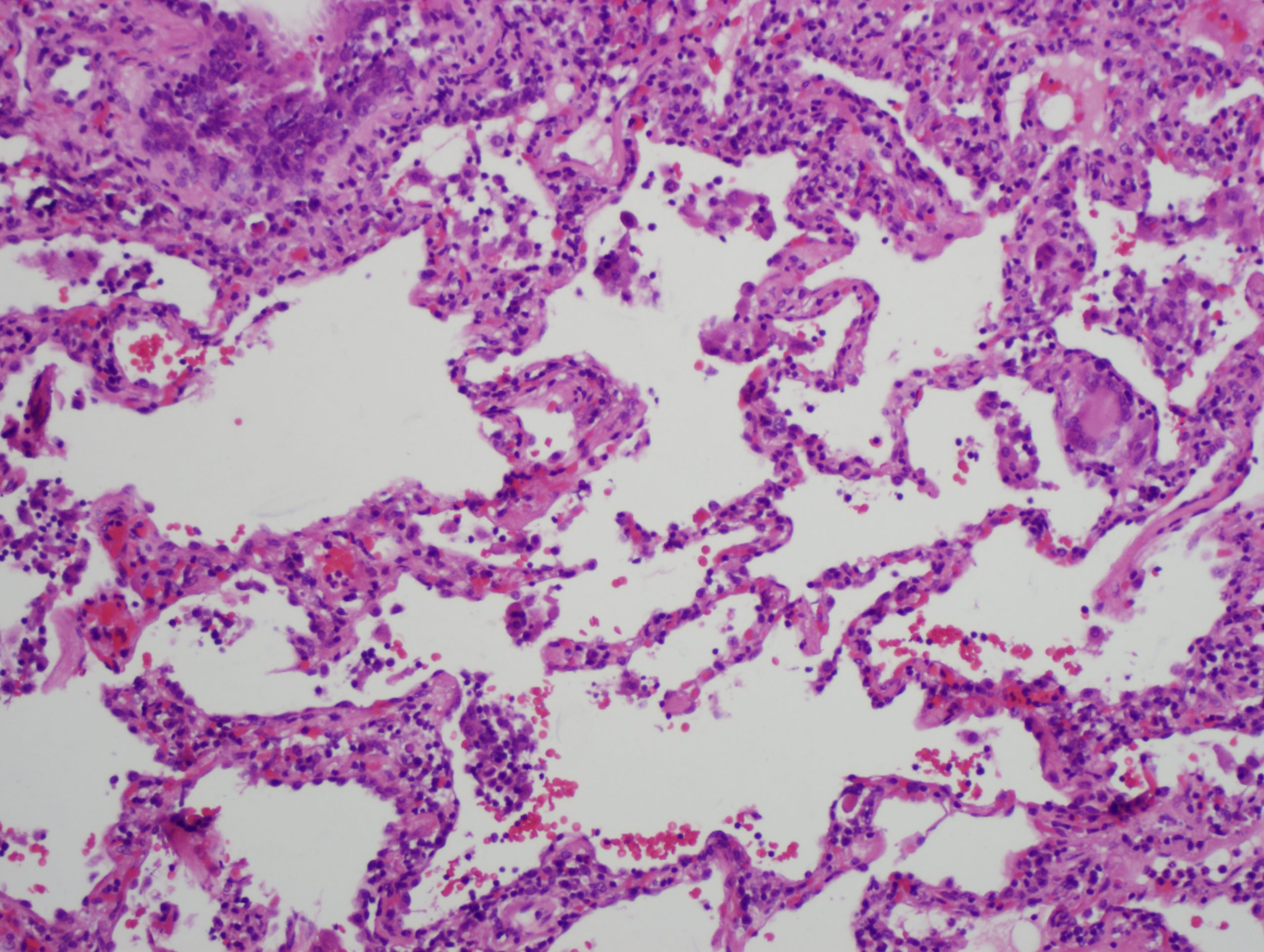 A histological slide of lung tissue shows open air spaces but there is severe thickening of the alveolar septum.