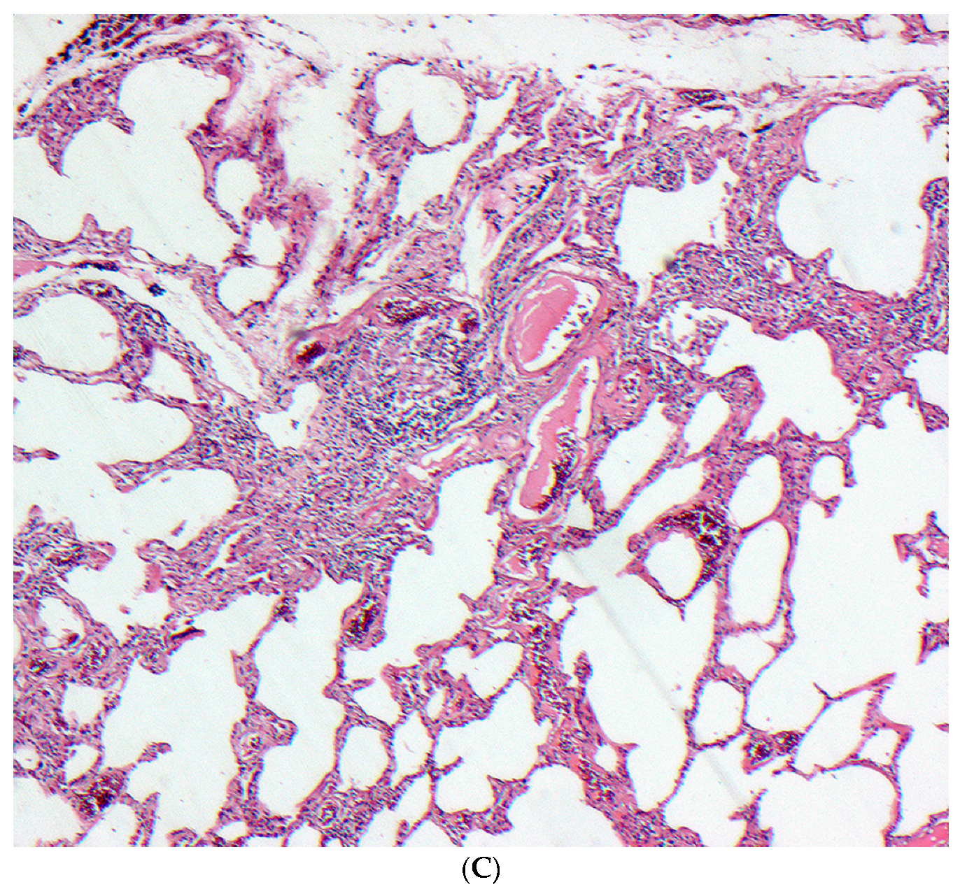 A histological slide of lung tissue shows open airspaces in the majority of the field of view but speta appear swollen and darker lines of tissue indicate the presence of fibrotic material.