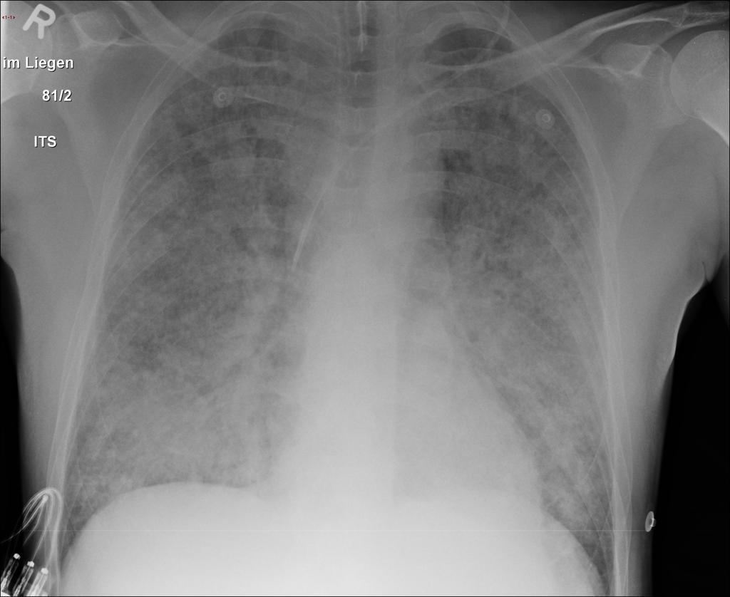 An A-P chest x-ray shows patchy consolidation throughout all lung fields. The markings forma uniform blotchy pattern throughout the lungs.