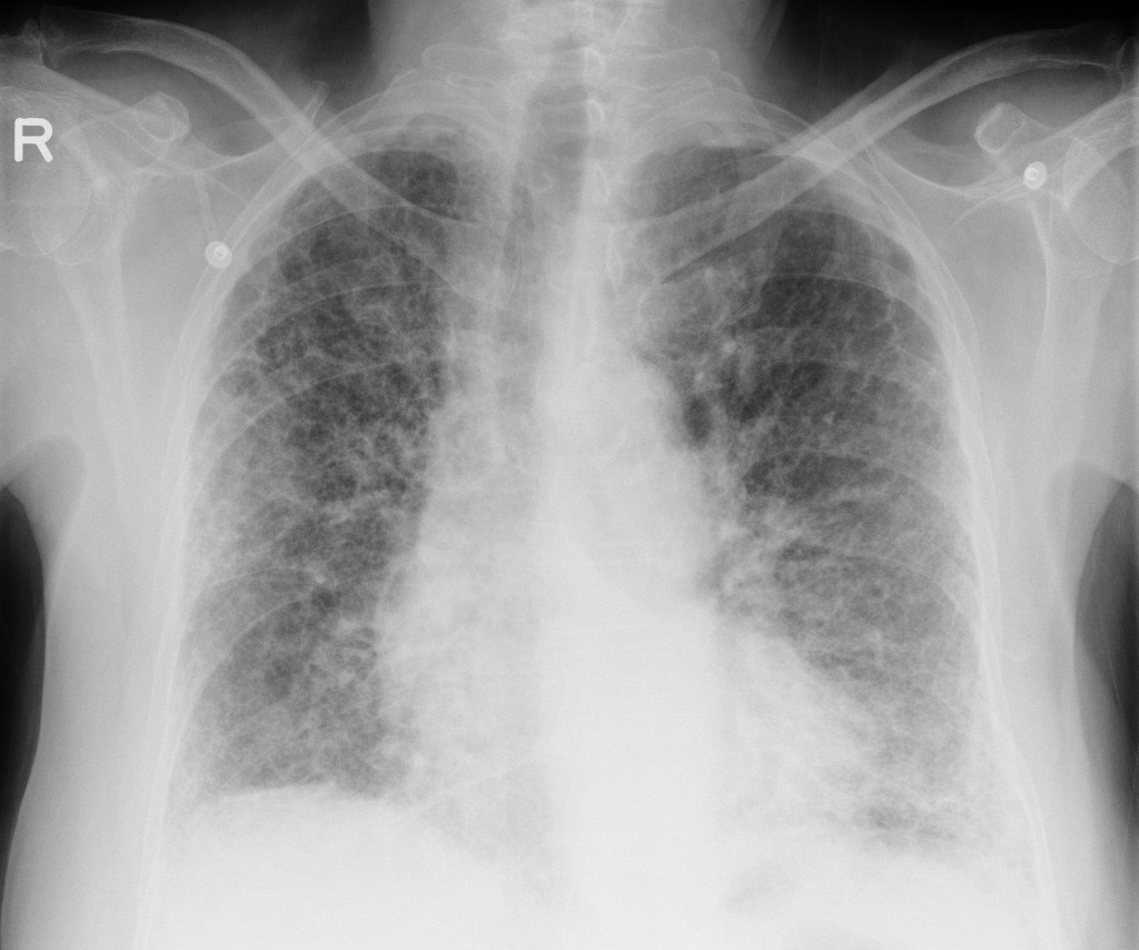 An A-P chest x-ray shows diffuse reticular markings that spread from the hilar regions throughout the lungs fields to the periphery. The markings form a web-like network that have uniform density across the lungs.