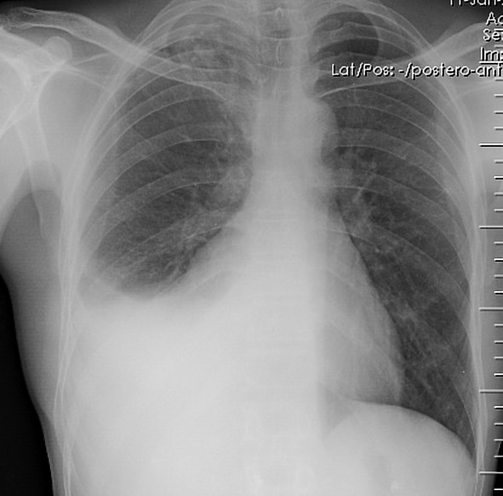 An A-P chest x-ray shows a whited-out region in the left lower quadrant of the thorax with a concave apical surface. The left lower lung is completely obscured by this feature.