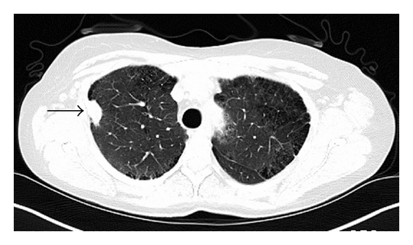 A transverse CT image of the lungs shows a bright white region on the medial surface of the right lung. The region is almost circular in shape and is labelled with an arrow indicating it is a nodular lesion.