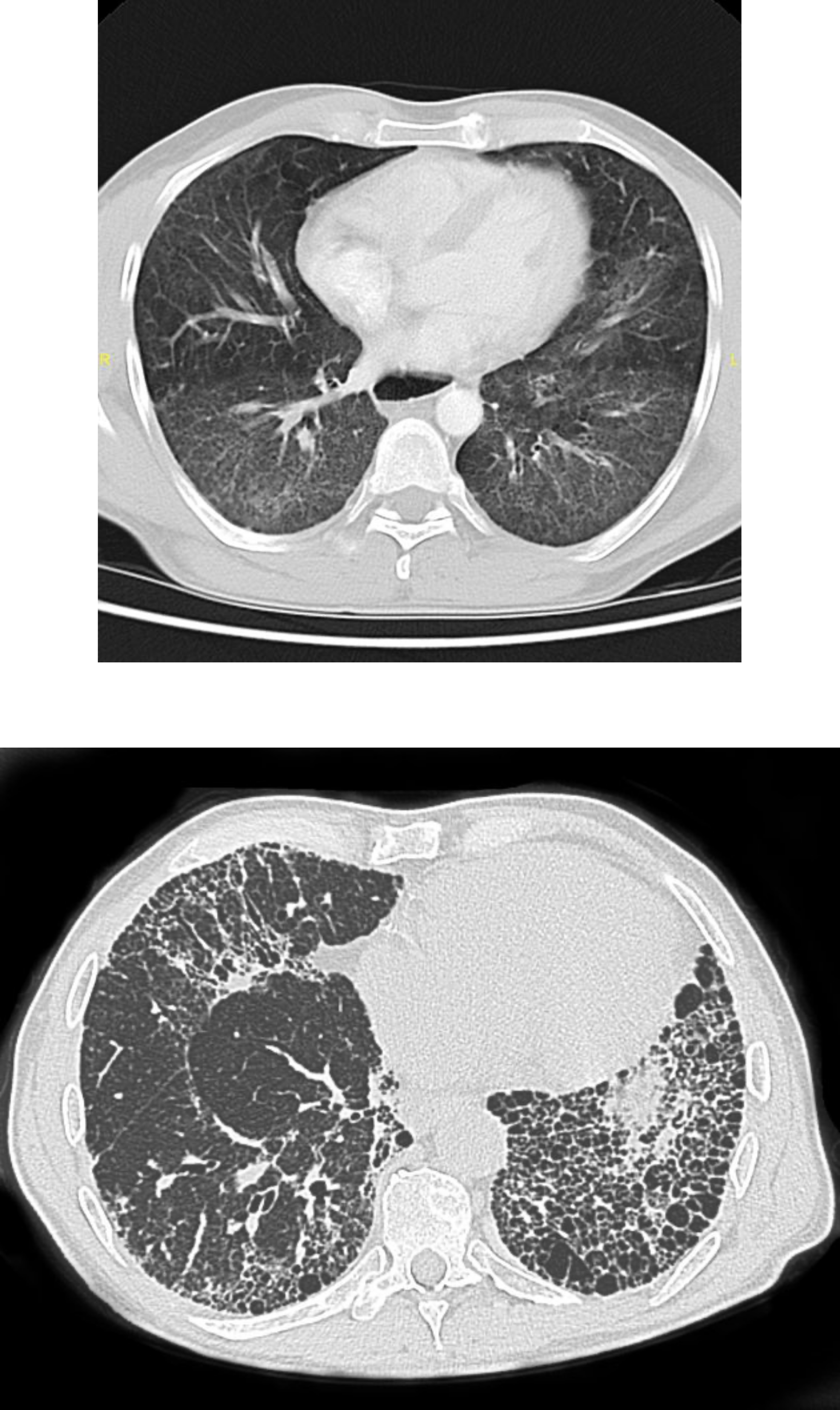Two transverse CT images of the lung are shown. The first shows diffuse, thin white markings networking throughout the lung fields shown. THe Second shows more course white markings, also throughout the lungs and these thicker markings form numerous adjacent circles that look like a honeycomb.