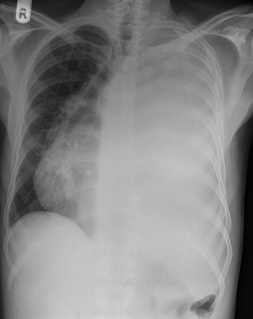 An A-P chest x-ray shows the lung side of the thorax is completely whited-out. The heart and mediastinal structures are shifted into the right side of the thorax.
