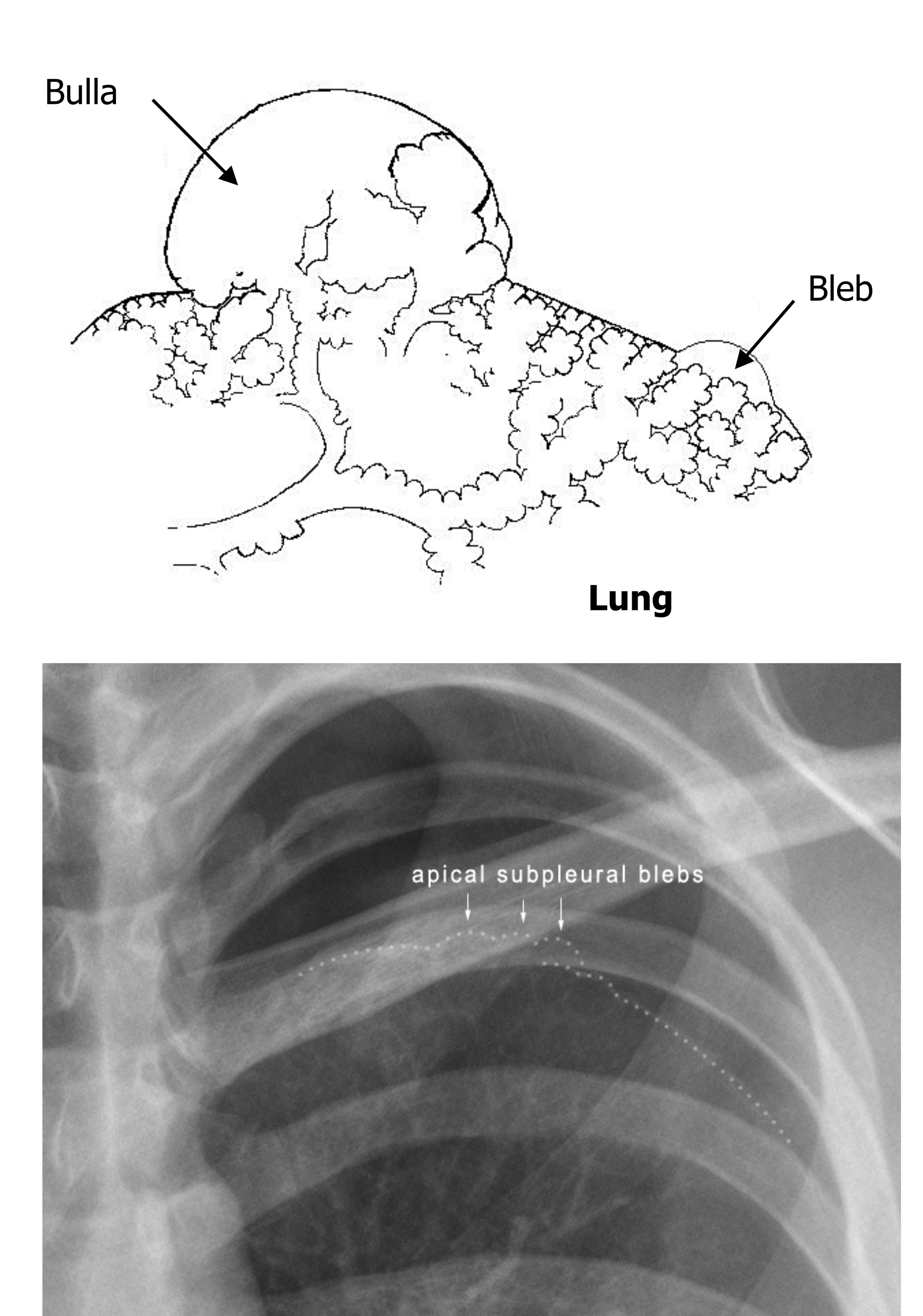 Two panels are shown the first is an illustration of the apical surface of the lung. A prominent bulge is shown at the top of the lung surface and is labelled a bulla. A smaller bugle is also shown next to the bull and is labelled a bleb. The second panel shows the upper left quadrant of an A-P chest x-ray. a dotted white line is overlaid to emphasis that the apical surface of the lung is distorted with three raised lumps that are labelled as apical subpleural blebs.
