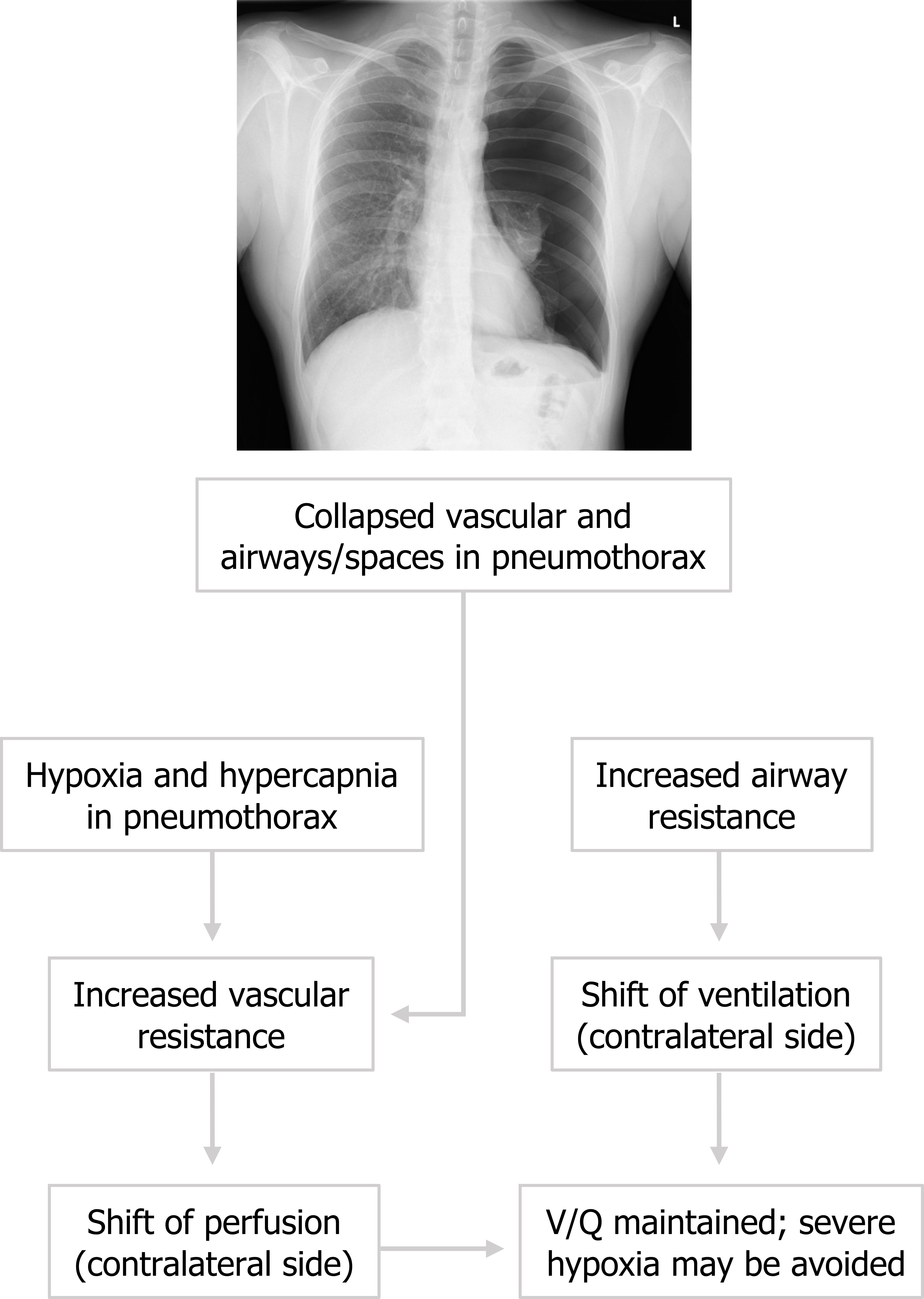 Collapsed vascular and airways/spaces in pneumothorax arrow to hypoxia and hypercapnia in pneumothorax arrow to increased vascular resistance arrow to shift of perfusion contralateral side arrow to V/Q maintained, severe hypoxia may be avoided. Collapsed vascular and airways/spaces in pneumothorax arrow to increased airway resistance arrow to shift of ventilation contralateral side arrow to V/Q maintained, severe hypoxia may be avoided. Collapsed vascular and airways/spaces in pneumothorax arrow to increased vascular resistance