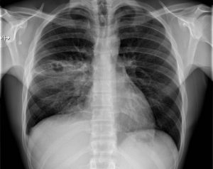 a chest x-ray that includes an area of increased opacity corresponding to the left middle lobe